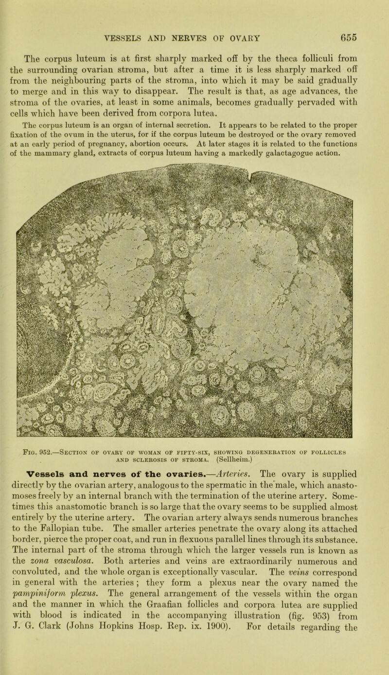 The corpus liiteiim is at first sharply marked ofi by the theca folliculi from the surrounding ovarian stroma, but after a time it is less sharply marked off from the neighbouring parts of the stroma, into which it may be said gradually to merge and in this way to disappear. The result is that, as age advances, the stroma of the ovaries, at least in some animals, becomes gradually pervaded with cells which have been derived from corpora lutea. The corpus luteum is an organ of internal secretion. It appears to be related to the proper fixation of the ovum in the uterus, for if the corpus luteum be destroyed or the ovary removed at an early period of pregnancy, abortion occurs. At later stages it is related to the functions of the mammary gland, extracts of corpus luteum having a markedly galactagogue action. Fig. 952.—Section of ovaby of woman of fifty-six, showing degenekation of follicles AND SCLEKOSIS OF STROMA. (Sellheim.) Vessels and nerves of the ovaries.—Arteries. The ovary is supplied directly by the ovarian artery, analogous to the spermatic in the'male, which anasto- moses freely by an internal branch with the termination of the uterine artery. Some- times this anastomotic branch is so large that the ovary seems to be supplied almost entirely by the uterine artery. The ovarian artery always sends numerous branches to the Fallopian tube. The smaller arteries penetrate the ovary along its attached border, pierce the proper coat, and run in flexuous parallel lines through its substance. The internal part of the stroma through which the larger vessels run is known as the zona vasculosa. Both arteries and veins are extraordinarily numerous and convoluted, and the whole organ is exceptionally vascular. The veins correspond in general with the arteries ; they form a plexus near the ovary named the 'pampiniform plexus. The general arrangement of the vessels within the organ and the manner in which the Graafian follicles and corpora lutea are supplied with blood is indicated in the accompanying illustration (fig. 953) from J. G. Clark (Johns Hopkins Hosp. Rep. ix. 1900). For details regarding the