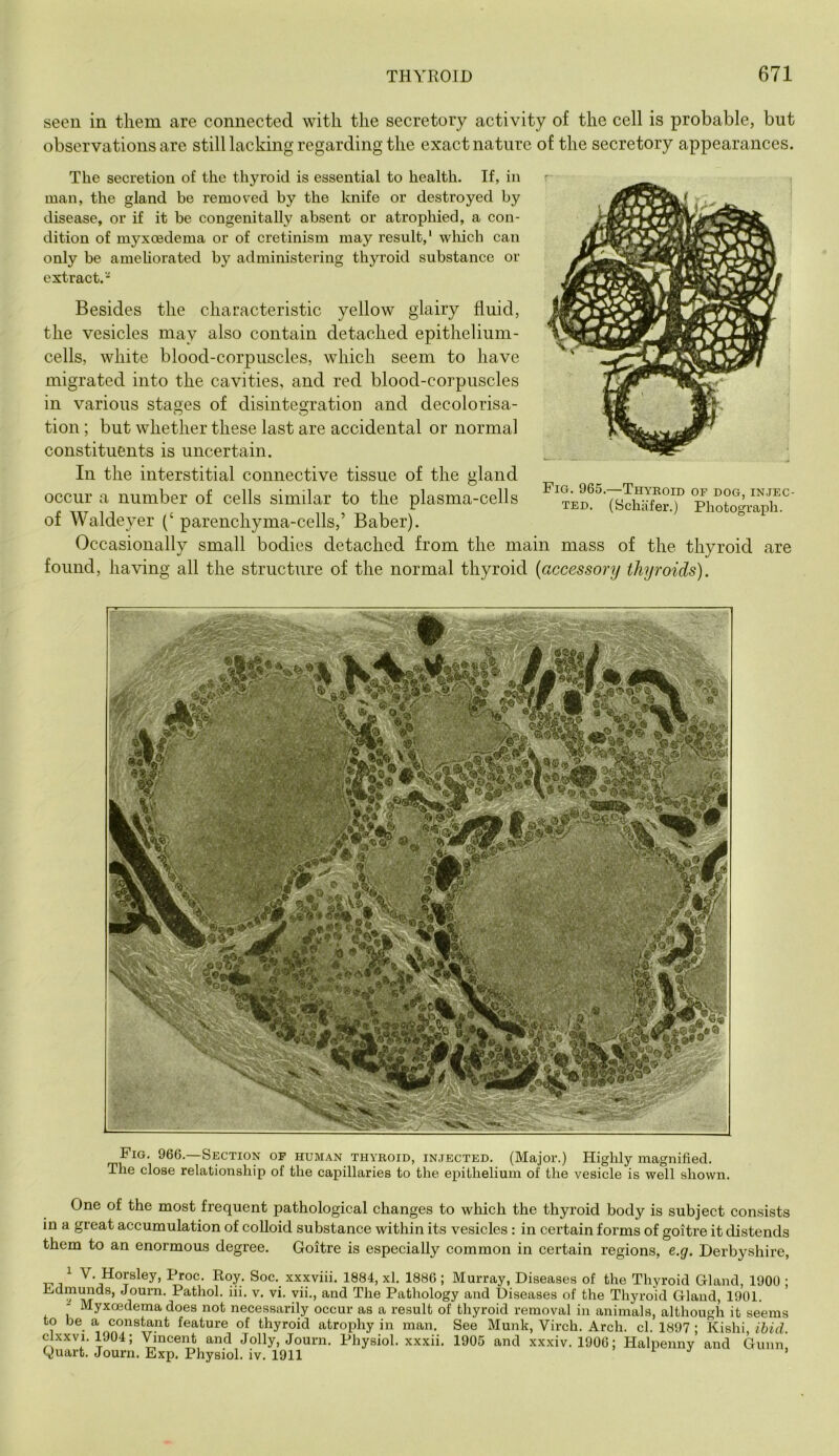 seen in them are connected with the secretory activity of the cell is probable, but observations are still lacking regarding the exact nature of the secretory appearances. The secretion of the thyroid is essential to health. If, in man, the gland be removed by the knife or destroyed by disease, or if it be congenitally absent or atrophied, a con- dition of myxoedema or of cretinism may result,' wliich can only be amehorated by administering thyroid substance or extract.- Besides the characteristic yellow glairy fluid, the vesicles may also contain detached epithelium- cells, white blood-corpuscles, which seem to have migrated into the cavities, and red blood-corpuscles in various sta2;es of disinteo;ration and decolorisa- tion; but whether these last are accidental or normal constituents is uncertain. In the interstitial connective tissue of the gland occur a number of cells similar to the plasma-cells of Waldeyer (‘ parenchyma-cells,’ Baber). Occasionally small bodies detached from the main mass of the thyroid are found, having all the structure of the normal thyroid {accessory thyroids). Fig. 965.—Thyroid of dog, in.iec- TED. (Schiifer.) Photograph. Fig. 966.—Section of human thyroid, injected. (Major.) Highly magnified. The close relationship of the capillaries to the epithelium of the vesicle is well shown. One of the most frequent pathological changes to which the thyroid body is subject consists in a great accumulation of colloid substance within its vesicles: in certain forms of goitre it distends them to an enormous degree. Goitre is especially common in certain regions, e.g. Derbyshire, ^ V. Horsley, Proc. Roy. Soc. xxxviii. 1884, xl. 1886 ; Murray, Diseases of the Thyroid Gland, 1900 ; Pathology and Diseases of the Thyroid Gland, 1901. - Myxoedema does not necessarily occur as a result of thyroid removal in animals, although it seems to be a constant feature of thyroid atrophy in man. See Munk, Virch. Arch. cl. 1897 ; Kishi ibid. clxxvi. 1904; Vincent and Jolly, Journ. Physiol, xxxii. 1905 and xxxiv. 1906; Halpenny and Gunn Quart. Journ. Exp. Physiol, iv. 1911 > i j i