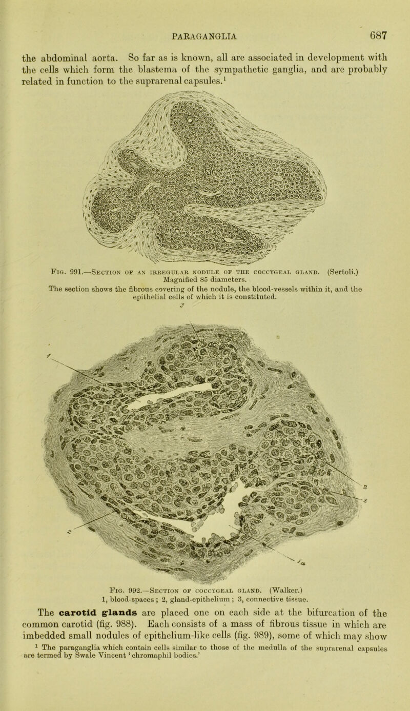 the abdominal aorta. So far as is known, all are associated in development with the cells which form the blastema of the sympathetic ganglia, and arc probably related in function to the suprarenal capsules. * Fig. 991.—Section op an irregular nodule of the coccygeal gland. (Sertoli.) Magnified 85 diameters. The section shows the fibrous covering of the nodule, the blood-vessels within it, and the epithelial cells of which it is constituted. Fig. 992.—Section op coccygeal gland. (Walker.) 1, blood-spaces ; 2, gland-epithelium ; 3, connective tissue. The carotid grlands are placed one on each side at the bifurcation of the common carotid (fig. 988). Each consists of a mass of fibrous tissue in which are imbedded small nodules of epithelium-hke cells (fig. 989), some of which may show ^ The paraganglia which contain cells similar to those of the medulla of the suprarenal capsules are termed by Swale Vincent ‘chromaphil bodies.’
