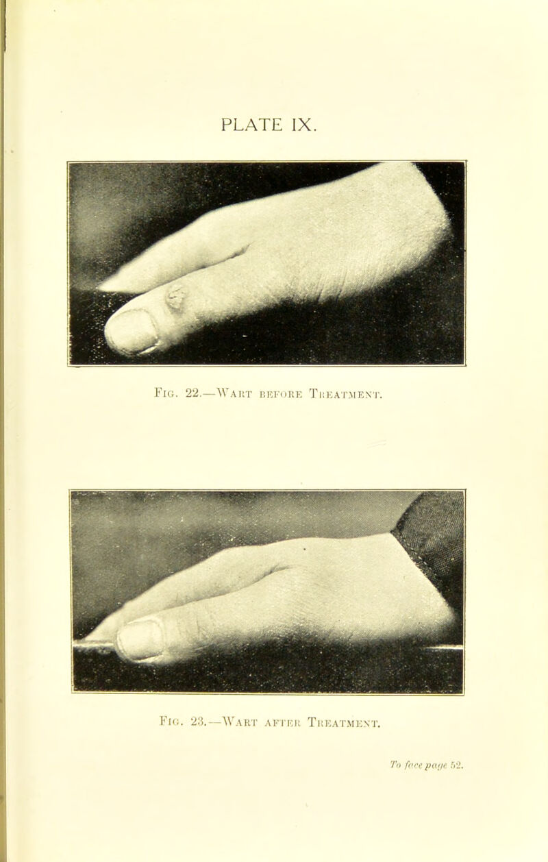 Fig. 22.—AVaut defore Treatment. Fig. 23.—AVart after Treatment. 7V> fore pa(je 5‘i.