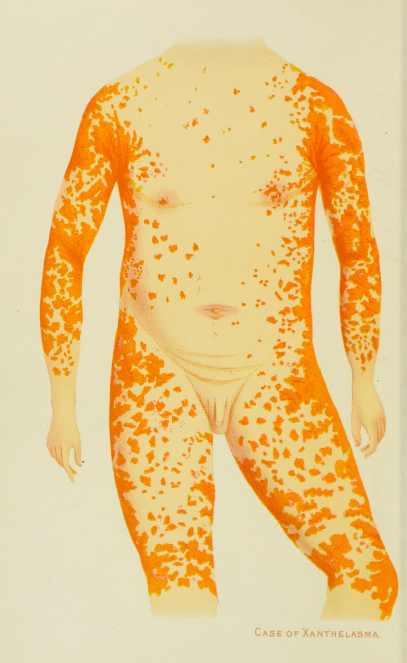 Case of Xanth elasma.