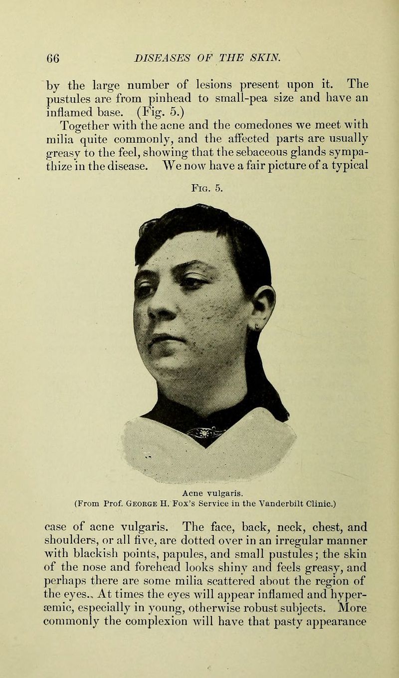 by the large number of lesions present upon it. The pustules are from pinhead to small-pea size and have an inflamed base. (Fig. 5.) Together with the acne and the comedones we meet with milia quite commonly, and the affected parts are usually greasy to the feel, showing that tlie sebaceous glands sympa- thize in the disease. W e now have a fair picture of a typical Fig. 5. Acne vulgaris. (From Prof. George H. Fox’s Service in the Vanderbilt Clinic.) case of acne vulgaris. The face, back, neck, chest, and shoulders, or all five, are dotted over in an irregular manner with blackish points, papules, and small pustules; the skin of the nose and forehead looks shiny and feels greasy, and perhaps there are some milia scattered about the region of the eyes.. At times the eyes will ajipear inflamed and hyper- semic, especially in young, otherwise robust subjects. More commonly the complexion will have that pasty appearance