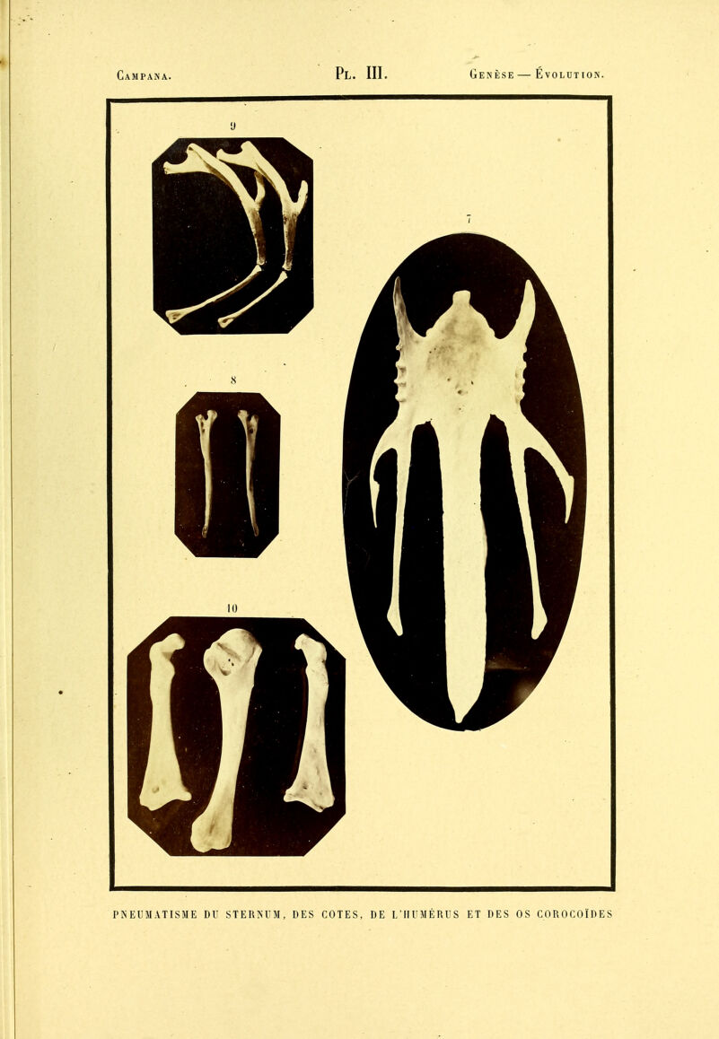 PNEUMATISME DU STERNUM, DES COTES, DE L'HUMÉRUS ET DES OS COROCOÏDES