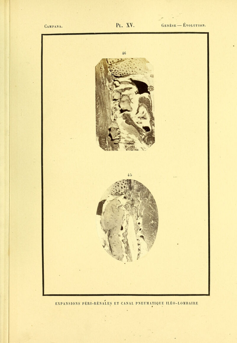 EXPANSIONS PÉRI-RÉNALES ET CANAL PNEUMATIQUE ILÉO-LOMBAIRE