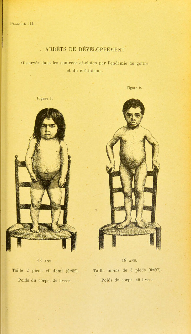 . ARRETS DE DÉVELOPPEMENT Observés dans les contrées atteintes par l'endémie du goilre et du crétinisme. Figure 2. Figure 1. 13 ANS. Taille 2 pieds et demi (0'82). 18 ANS. Taille moins de 3 pieds (0m97).
