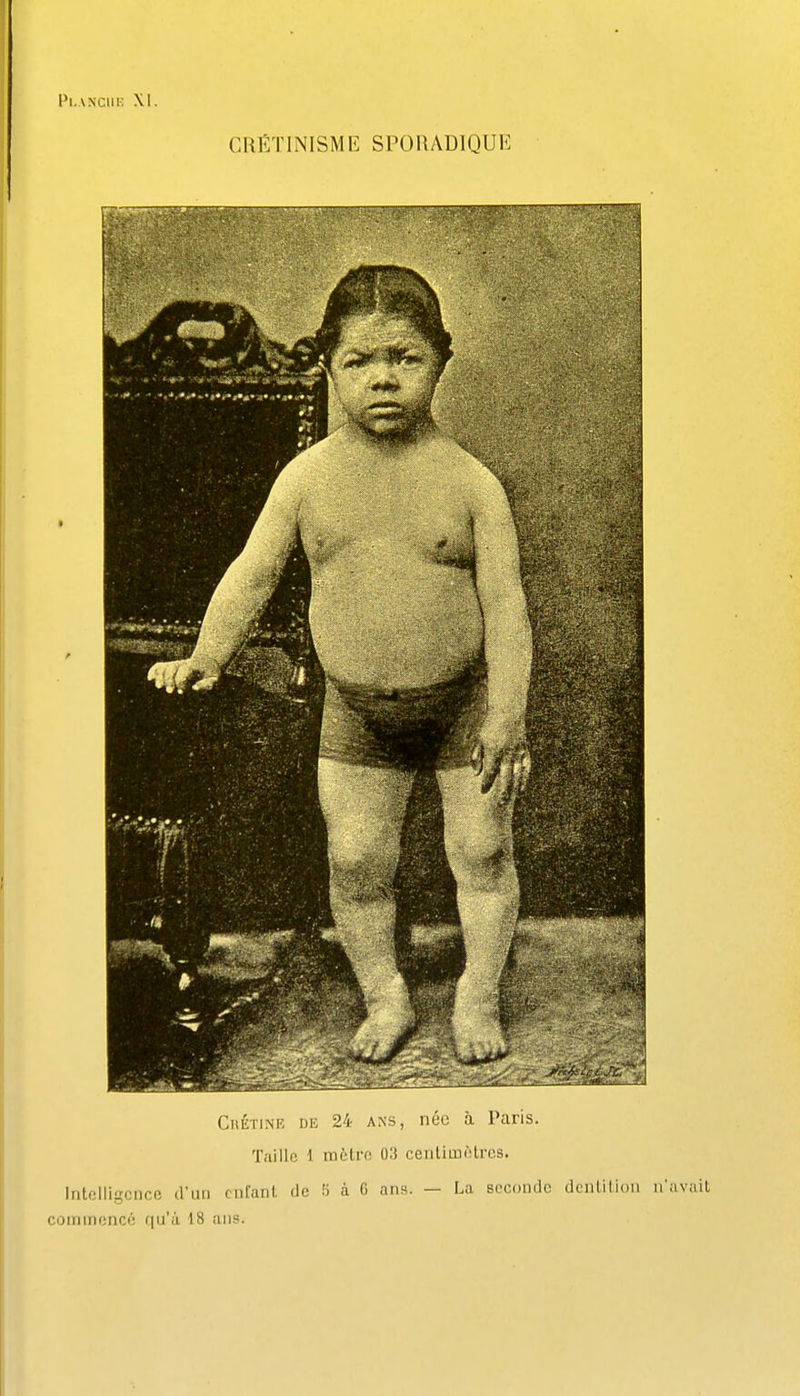 Pl.ANClIlv XI. CRËTINISME SPORADIQUE CiiÉTiNiî DE 24 ANS, née à Paris. Taille 1 inùlrc 03 centimotrcs. Intelligence d'un enfant de ri à G ans. — La seconde dcnlilion n'avait commencé rju'à 18 ans.
