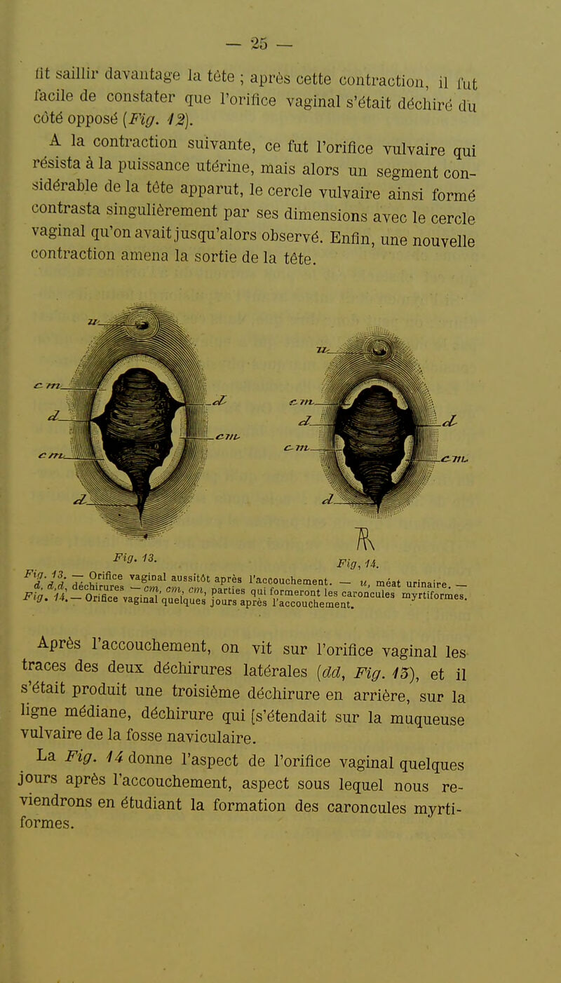 lit saillir davantage la tète ; après cette contraction, il fut facile de constater que l'orifice vaginal s'était déchiré du côté opposé [Fig. '12). A la contraction suivante, ce fut l'orifice vulvaire qui résista à la puissance utérine, mais alors un segment con- sidérable de la tête apparut, le cercle vulvaire ainsi formé contrasta singulièrement par ses dimensions avec le cercle vagmal qu'on avait jusqu'alors observé. Enfin, une nouvelle contraction amena la sortie de la tête. Fig. 13. ^'tPri 7- ^^'^^ i^i^iim après raccouchemeot. - u méat urinaire Après l'accouchement, on vit sur l'orifice vaginal les- traces des deux déchirures latérales [cld, Fig. 13), et il s'était produit une troisième déchirure en arrière, 'sur la ligne médiane, déchirure qui (s'étendait sur la muqueuse vulvaire de la fosse naviculaire. La Fig. U donne l'aspect de l'orifice vaginal quelques jours après l'accouchement, aspect sous lequel nous re- viendrons en étudiant la formation des caroncules myrti- formes.