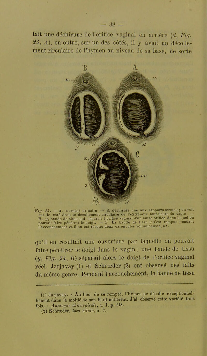 — es- tait une déchirure de roriflce vaginal eu arrière [d, Fig. 24, A), en outre, sur un des côtés, il y avait un décolle- ment circulaire de l'hymen au niveau de sa base, de sorte Fig. H. —A. «.méat urinaire. — à, déchirure due aux rapports sexuels; on voit sur le côté droit le décollement circulaire de l'extrémité antérieure du vagm. — B. y, bande de tissu qui séparait l'orifice vaginal d'un autre orifice dans leciuel on pouvait faire pénétrer le doigt. — C La bande de tissu y s'est rompue pendant l'accouchement et il en est résulté deux caroncules volumineuses, zz. qu'il en résultait une ouverture par laquelle on pouvait faire pénétrer le doigt dans le vagin; une hande de tissu {y, Fig. 24, B) séparait alors le doigt de l'orifice vaginal réel. Jarjavay (1) et Schrœder (2) ont observé des faits du même genre. Pendant l'accouchement, la bande de tissu (1) Jarjavay. « Au lieu de se rompre, Thymeii se décolle exceptionnel- lement dans la moitié de son bord adbérent. J'ai observé cette variété trois fois. » Anatomie chirurgicale, t. I, p. 318. (2) Schrœder, loco citato, p. 7.