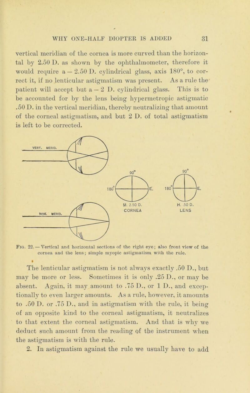 vertical meridian of the cornea is more curved than the horizon- tal by 2.50 1). as shown by the ophthalmometer, therefore it would require a—2.50 D. cylindrical glass, axis 180°, to cor- rect it, if no lenticular astigmatism was present. As a rule the- patient will accept but a —2 D. cylindrical glass. This is to be accounted for by the lens being hypermetropic astigmatic .50 D. in the vertical meridian, thereby neutralizing that amount of the corneal astigmatism, and but 2 D. of total astigmatism is left to be corrected. Fig. 22.— Vertical and horizontal sections of the right eye; also front view of the cornea and the lens; simple myopic astigmatism with the rule. The lenticular astigmatism is not always exactly .50 D., but may be more or less. Sometimes it is only .25 D., or may be absent. Again, it may amount to .75 I)., or 1 D., and excep- tionally to even larger amounts. As a rule, however, it amounts to .50 D. or .75 D., and in astigmatism with the rule, it being of an opposite kind to the corneal astigmatism, it neutralizes to that extent the corneal astigmatism. And that is why we deduct such amount from the reading of the instrument when the astigmatism is with the rule. 2. In astigmatism against the rule we usually have to add