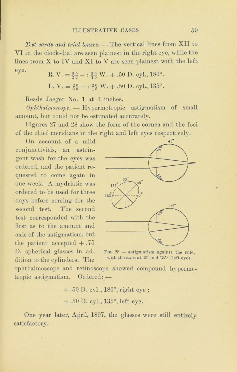 Test cards and trial lenses. —The vertical lines from XII to VI in the clock-dial are seen plainest in the right eye, while the lines from X to IV and XI to V are seen plainest with the left eye‘ Ii. V. = f# - : f | W. + .50 D. cyl., 180°. L. V. = -§# - : W. + .50 D. cyl., 135°. Reads Jaeger No. 1 at 3 inches. Ophthalmoscope. — Hypermetropic astigmatism of small amount, but could not be estimated accurately. Figures 27 and 28 show the form of the cornea and the foci of the chief meridians in the right and left eyes respectively. On account of a mild conjunctivitis, an astrin- gent wash for the eyes was ordered, and the patient re- quested to come again in one week. A mydriatic was ordered to be used for three days before coming for the second test. The second test corresponded with the first as to the amount and axis of the astigmatism, but the patient accepted + .75 D. spherical glasses in ad- dition to the cylinders. The ophthalmoscope and retinoscope showed compound hyperme- tropic astigmatism. Ordered: — + .50 D. cyl., 180°, right eye ; + .50 D. cyl., 135°, left eye. One year later, April, 1897, the glasses were still entirely satisfactory. 45° Fig. 28. — Astigmatism against the rule, with the axes at 45° and 135° (left eye).