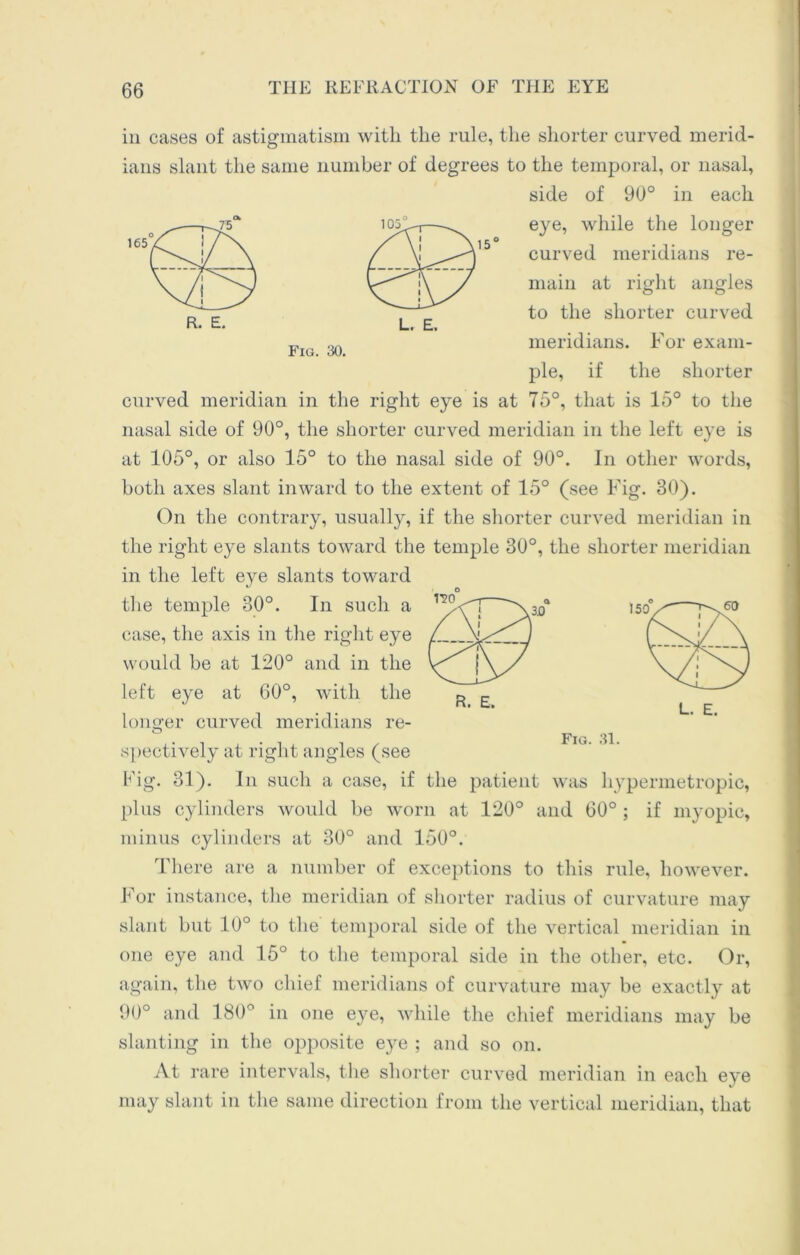 R. E. L. E. Fig. 30. in cases of astigmatism with the rule, the shorter curved merid- ians slant the same number of degrees to the temporal, or nasal, side of 90° in each eye, while the longer curved meridians re- main at right angles to the shorter curved meridians. For exam- ple, if the shorter curved meridian in the right eye is at 75°, that is 15° to the nasal side of 90°, the shorter curved meridian in the left eye is at 105°, or also 15° to the nasal side of 90°. In other words, both axes slant inward to the extent of 15° (see Fig. 30). On the contrary, usually, if the shorter curved meridian in the right eye slants toward the temple 30°, the shorter meridian in the left eye slants toward the temple 30°. In such a case, the axis in the right eye would be at 120° and in the left eye at 60°, with the longer curved meridians re- spectively at right angles (see Fig. 31). In such a case, if the patient was hypermetropic, plus cylinders would be worn at 120° and 60° ; if myopic, minus cylinders at 30° and 150°. There are a number of exceptions to this rule, however. rso R. E. For instance, the meridian of shorter radius of curvature may slant but 10° to the temporal side of the vertical meridian in one eye and 15° to the temporal side in the other, etc. Or, again, the two chief meridians of curvature may be exactly at 90° and 180° in one eye, while the chief meridians may be slanting in the opposite eye ; and so on. At rare intervals, the shorter curved meridian in each eye may slant in the same direction from the vertical meridian, that
