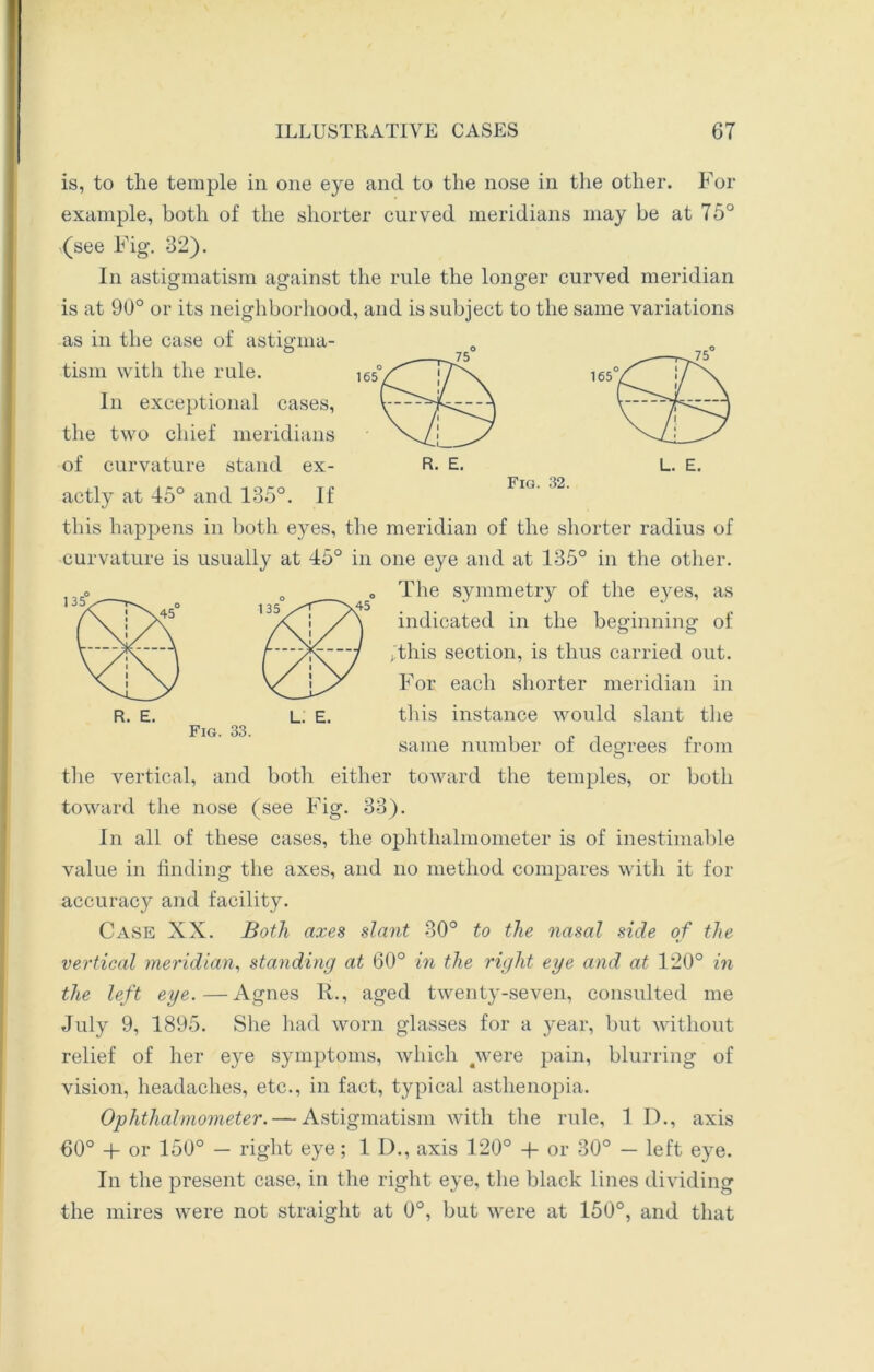 165 R. E. 135 is, to the temple in one eye and to the nose in the other. For example, both of the shorter curved meridians may be at 75° (see Fig. 32). In astigmatism against the rule the longer curved meridian is at 90° or its neighborhood, and is subject to the same variations as in the case of astigma- tism with the rule. In exceptional cases, the two chief meridians of curvature stand ex- actly at 45° and 135°. If this happens in both eyes, the meridian of the shorter radius of curvature is usually at 45° in one eye and at 135° in the other. The symmetry of the eyes, as indicated in the beginning of j this section, is thus carried out. For each shorter meridian in this instance would slant the same number of degrees from the vertical, and both either toward the temples, or both toward the nose (see Fig. 33). In all of these cases, the ophthalmometer is of inestimable value in finding the axes, and no method compares with it for accuracy and facility. Case XX. Both axes slant 30° to the nasal side of the vertical meridian, standing at 60° in the right eye and at 120° in the left eye.—Agnes R., aged twenty-seven, consulted me July 9, 1895. She had worn glasses for a year, but without relief of her eye symptoms, which 4were pain, blurring of vision, headaches, etc., in fact, typical asthenopia. Ophthalmometer. — Astigmatism with the rule, 1 I)., axis 60° + or 150° — right eye; 1 D., axis 120° + or 30° — left eye. In the present case, in the right eye, the black lines dividing the mires were not straight at 0°, but were at 150°, and that Fig. 33. L. E.
