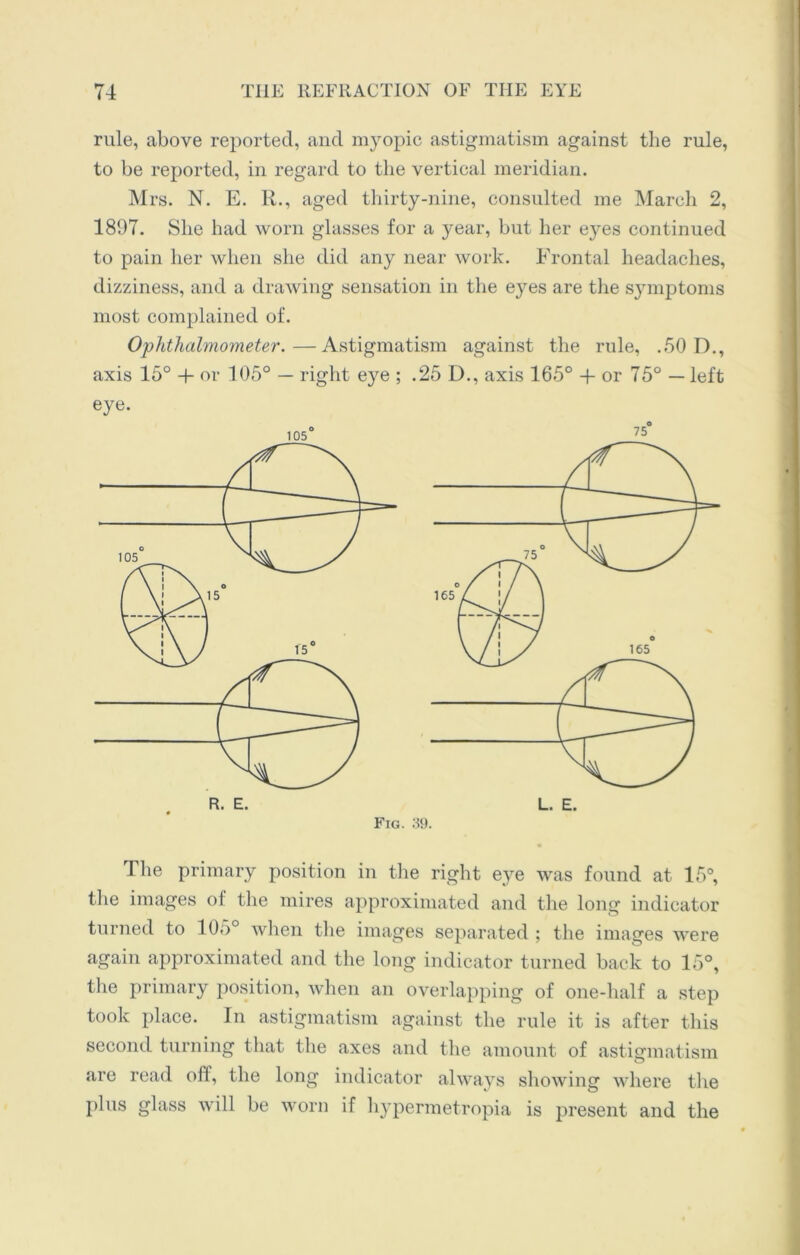 rule, above reported, and myopic astigmatism against the rule, to be reported, in regard to the vertical meridian. Mrs. N. E. R., aged thirty-nine, consulted me March 2, 1897. She had worn glasses for a year, but her e}^es continued to pain her when she did any near work. Frontal headaches, dizziness, and a drawing sensation in the eyes are the symptoms most complained of. Ophthalmometer.—Astigmatism against the rule, .50 0., axis 15° + or 105° — right eye ; .25 D., axis 165° 4- or 75° — left eye. Fig. 39. The primary position in the right eye was found at 15°, the images of the mires approximated and the long indicator turned to 105° when the images separated ; the images were again approximated and the long indicator turned back to 15°, the primary position, when an overlapping of one-half a step took place. In astigmatism against the rule it is after this second turning that the axes and the amount of astigmatism are read olf, the long indicator always showing where the plus glass will be worn if hypermetropia is present and the