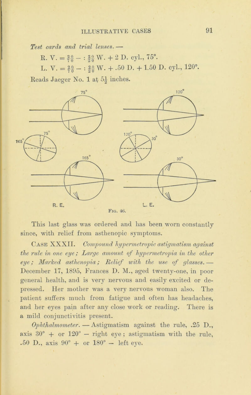 Test cards and trial lenses. — R. V. = 20 _ . |o W. + 2 D. cyl., 75°. L. Y. = 20 _ : |o w. + .50 D. + 1.50 D. cyl., 120°. Reads Jaeger No. 1 at 5|- inches. 75° 120° Fig. 46. This last glass was ordered and has been worn constantly since, with relief from asthenopic symptoms. Case XXXII. Compound hypermetropic astigmatism against the rule in one eye; Large amount of hypermetropia in the other eye; Marked asthenopia; Relief with the use of glasses. — December 17, 1895, Frances D. M., aged twenty-one, in poor general health, and is very nervous and easily excited or de- pressed. Her mother was a very nervous woman also. The patient suffers much from fatigue and often has headaches, and her eyes pain after any close work or reading. There is a mild conjunctivitis present. Ophthalmometer. — Astigmatism against the rule, .25 D., axis 30° + or 120° — right eye ; astigmatism with the rule, .50 D., axis 90° + or 180° — left eye.