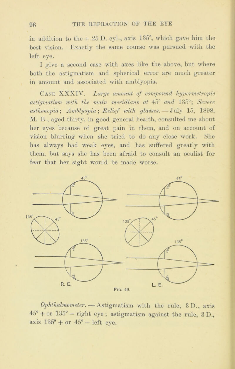 in addition to the+.25 D. cyl., axis 135°, which gave him the best vision. Exactly the same course was pursued with the left eye. 1 give a second case with axes like the above, but where both the astigmatism and spherical error are much greater in amount and associated with amblyopia. Case XXXIV. Large amount of compound hypermetropic astigmatism with the main meridians at 45° and 135°; Severe asthenopia’, Amblyopia ; Relief with glasses. — July 15, 1898, M. B., aged thirty, in good general health, consulted me about her eyes because of great pain in them, and on account of vision blurring when she tried to do any close work. She has always had weak eyes, and has suffered greatly with them, but says she has been afraid to consult an oculist for fear that her sight would be made worse. 45° 45° Ophthalmometer.—Astigmatism with the rule, 3D., axis 45u + or 135° — right eye ; astigmatism against the rule, 3 D., axis 135® + or 45° — left eye.