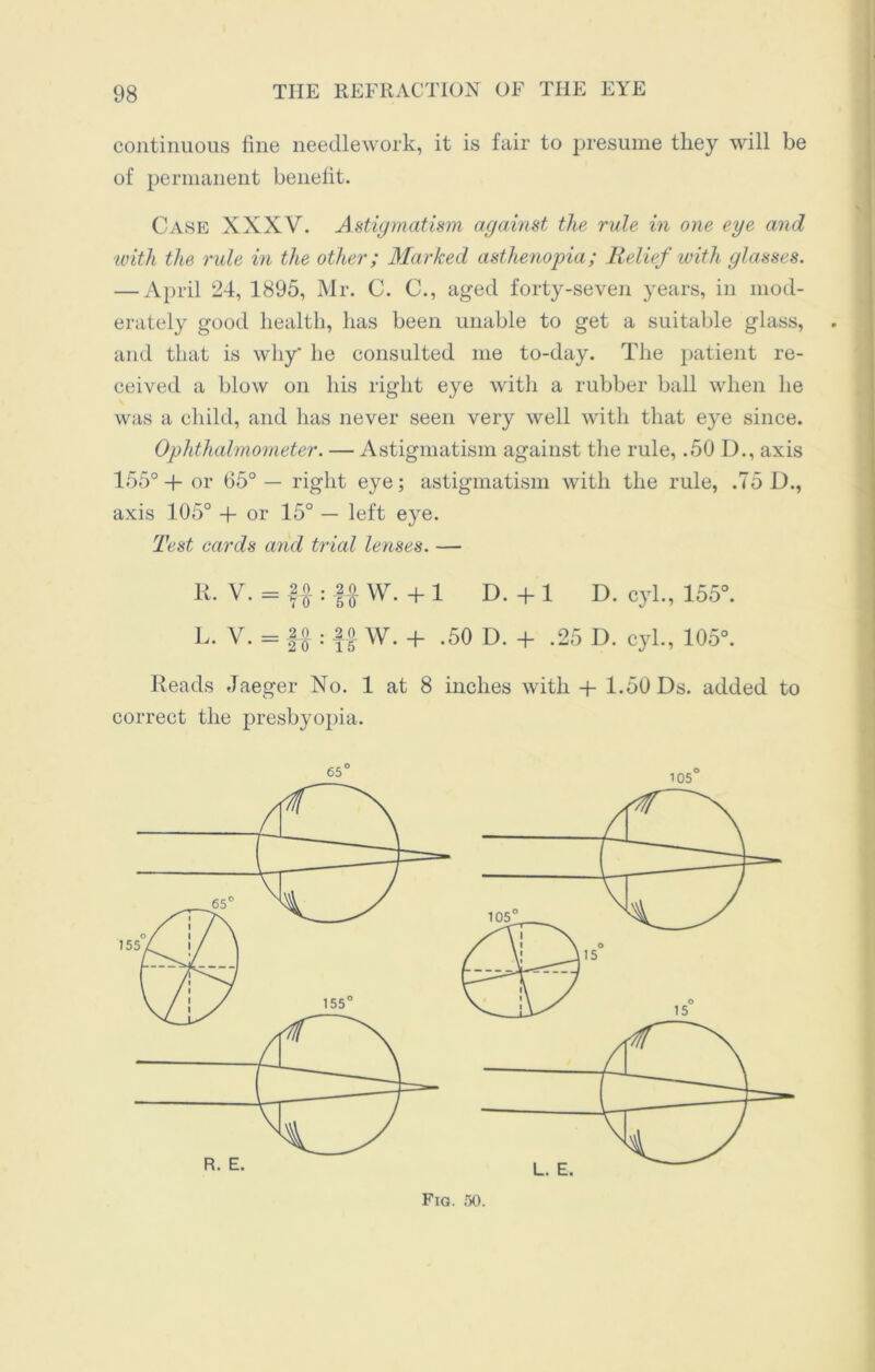 continuous fine needlework, it is fair to presume they will be of permanent benefit. Case XXXV. Astigmatism against the rule in one eye and with the rule in the other; Marked asthenopia; Relief with glasses. — April 24, 1895, Mr. C. C., aged forty-seven years, in mod- erately good health, has been unable to get a suitable glass, and that is why' he consulted me to-day. The patient re- ceived a blow on his right eye with a rubber ball when he was a child, and has never seen very well with that eye since. Ophthalmometer. — Astigmatism against the rule, .50 D., axis 155° H- or 65° — right eye; astigmatism with the rule, .75 D., axis 105° + or 15° — left eye. Test cards and trial lenses. — R. V. = f A : f A W. + 1 D. + 1 D. cyl., 155°. L. V. = f a ; lo w. + .50 D. + .25 D. cyl., 105°. Reads Jaeger No. 1 at 8 inches with + 1.50 Ds. added to correct the presbyopia.