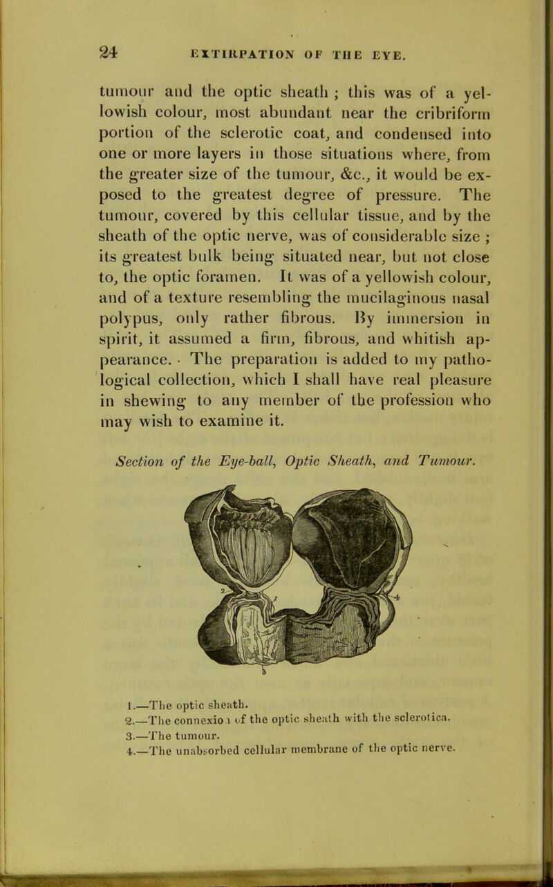 tumour and the optic sheath ; this was of a yel- lowish colour, most abundant near the cribriform portion of the sclerotic coat, and condensed into one or more layers in those situations where, from the greater size of the tumour, &c., it would be ex- posed to the greatest degree of pressure. The tumour, covered by this cellular tissue, and by the sheath of the optic nerve, was of considerable size ; its greatest bulk being situated near, but not close to, the optic foramen. It was of a yellowish colour, and of a texture resembling the mucilaginous nasal polypus, oidy rather fibrous. By immersion in spirit, it assumed a firm, fibrous, and whitish ap- pearance. • The preparation is added to my patho- logical collection, which I shall have real pleasure in shewing to any member of the profession who may wish to examine it. Section of the Eye-hall, Optic Sheath, and Tumour. 1. —The optic sheath. 2. —The connexion of the optic sheath with the sclerotica. 3. —The tumour. 4. —The unabsorbed cellular membrane of the optic nerve.