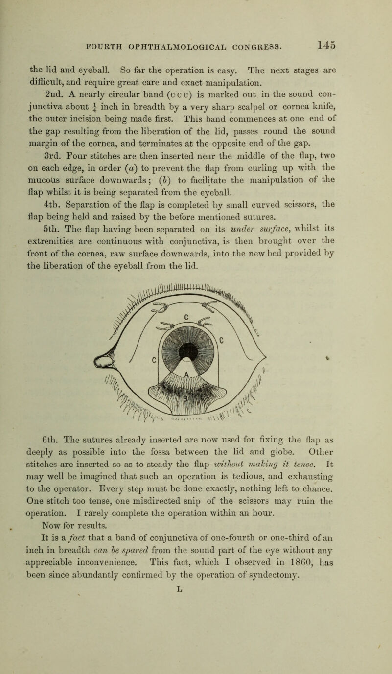 the lid and eyeball. So far the operation is easy. The next stages are difficult, and require great care and exact manipulation. 2nd. A nearly circular band (c C c) is marked out in the sound con- junctiva about 4 inch in breadth by a very sharp scalpel or cornea knife, the outer incision being made first. This band commences at one end of the gap resulting from the liberation of the lid, passes round the sound margin of the cornea, and terminates at the opposite end of the gap. 3rd. Four stitches are then inserted near the middle of the flap, two on each edge, in order (a) to prevent the flap from curling up with the mucous surface downwards ; (h) to facilitate the manipulation of the flap whilst it is being separated from the eyeball. 4th. Separation of the flap is completed by small curved scissors, the flap being held and raised by the before mentioned sutures. 5th. The flap having been separated on its under surface, whilst its extremities are continuous with conjunctiva, is then brought over the front of the cornea, raw surface downwards, into the new bed provided by the liberation of the eyeball from the lid. 6th. The sutures already inserted are now used for fixing the flap as deeply as possible into the fossa between the lid and globe. Other stitches are inserted so as to steady the flap without making it tense. It may well be imagined that such an operation is tedious, and exhausting to the operator. Every step must be done exactly, nothing left to chance. One stitch too tense, one misdirected snip of the scissors may ruin the operation. I rarely complete the operation within an hour. Now for results. It is a fact that a band of conjunctiva of one-fourth or one-third of an inch in breadth can he spared from the sound part of the eye without any appreciable inconvenience. This fact, which I observed in 1860, has been since abundantly confirmed by the operation of syndectomy. L