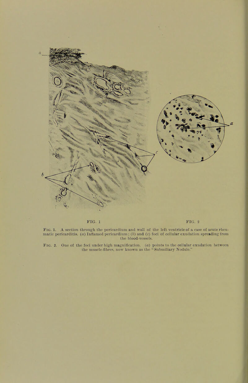 Fig. 1. A section through the pericardium and wall of the left ventricle of a case of acute rheu- matic pericarditis, (a) Inflamed pericardium; (£>) and (c) foci of cellular exudation spreading from the blood-vessels. Fig. 2. One of the foci under high magnification, (a) points to the cellular exudatiuu between the muscle-fibres, now known as the  Subiniliary Nodule.