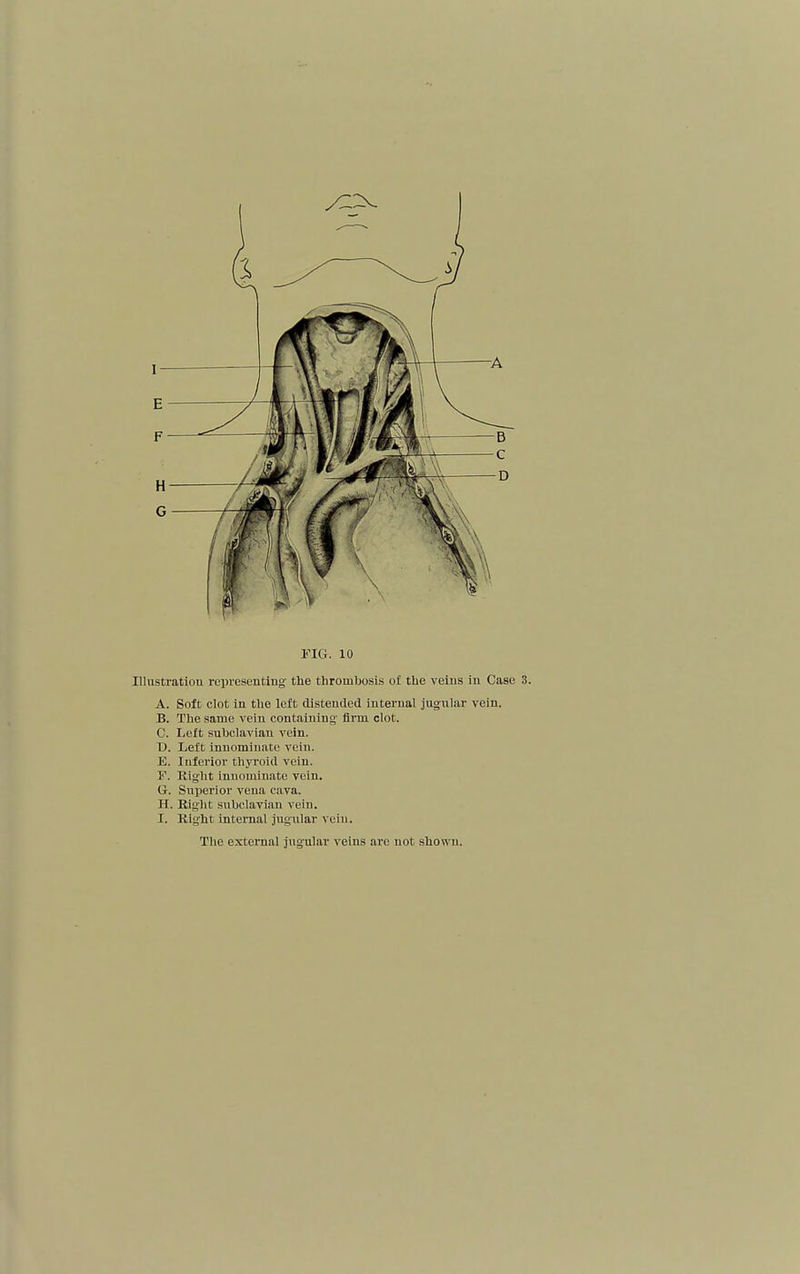 FIG. 10 Illustration representing the thrombosis of the veins in Case 3. A. Soft clot in the left distended internal jugular vein. B. The same vein containing firm clot. C. Left subclavian vein. D. Left innominate vein. E. Inferior thyroid vein. y. Right innominate vein. U. Superior vena cava. H. Right subclavian vein. I. Right internal jugular vein. The external jugular veins are not shown.