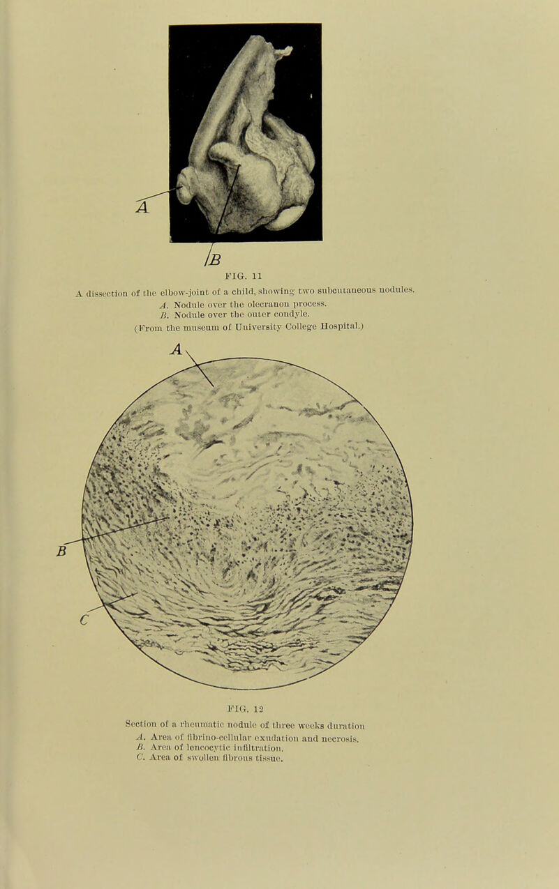 FIG. 11 A dissection of the elbow-joint o£ a child, showing two subcutaneous uodules. A. Nodule over the olecranon process. n. Nodule over the outer condyle. (From the museum of University College Hospital.) Ak FIG. 12 Scci inn of a rheumatic nodule of three weeks duration A. Area of florino-cellular exudation and necrosis. li. Area of leukocytic inliltration. C. Area of swollen nitrons tissue.