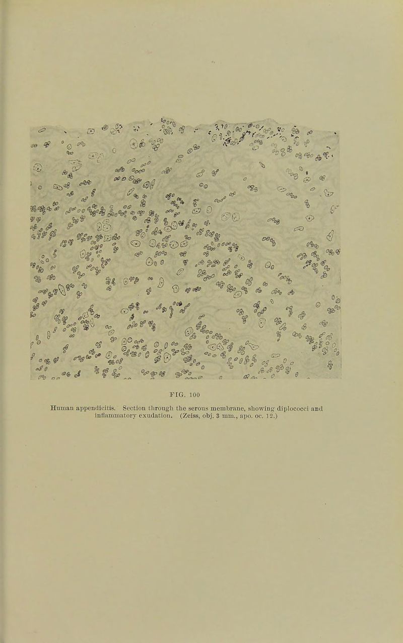 dp e FIG. 100 Human appendicitis. Section through the serous membrane, showing' diplocooci and inflammatory exudation. (Zeiss, obj. 3 mm., apo. oc. 12.)