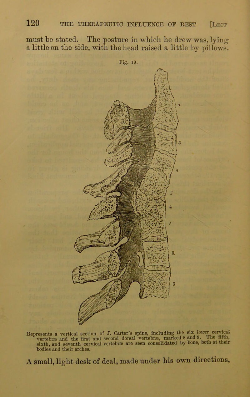 Represents a vertical section of J. Carter’s spine, including the sis.lower cervical vertebra; and the first and second dorsal vertebra;, marked 8 and 9. Ibe httb, sixth, and seventh cervical vertebra are seen consolidated by bone, both at their bodies and their arches. A small, light desk of deal, made under his own directions, must ho stated. The posture in which he drew was, lying a little on the side, with the head raised a little by pillows. Fig. 19.