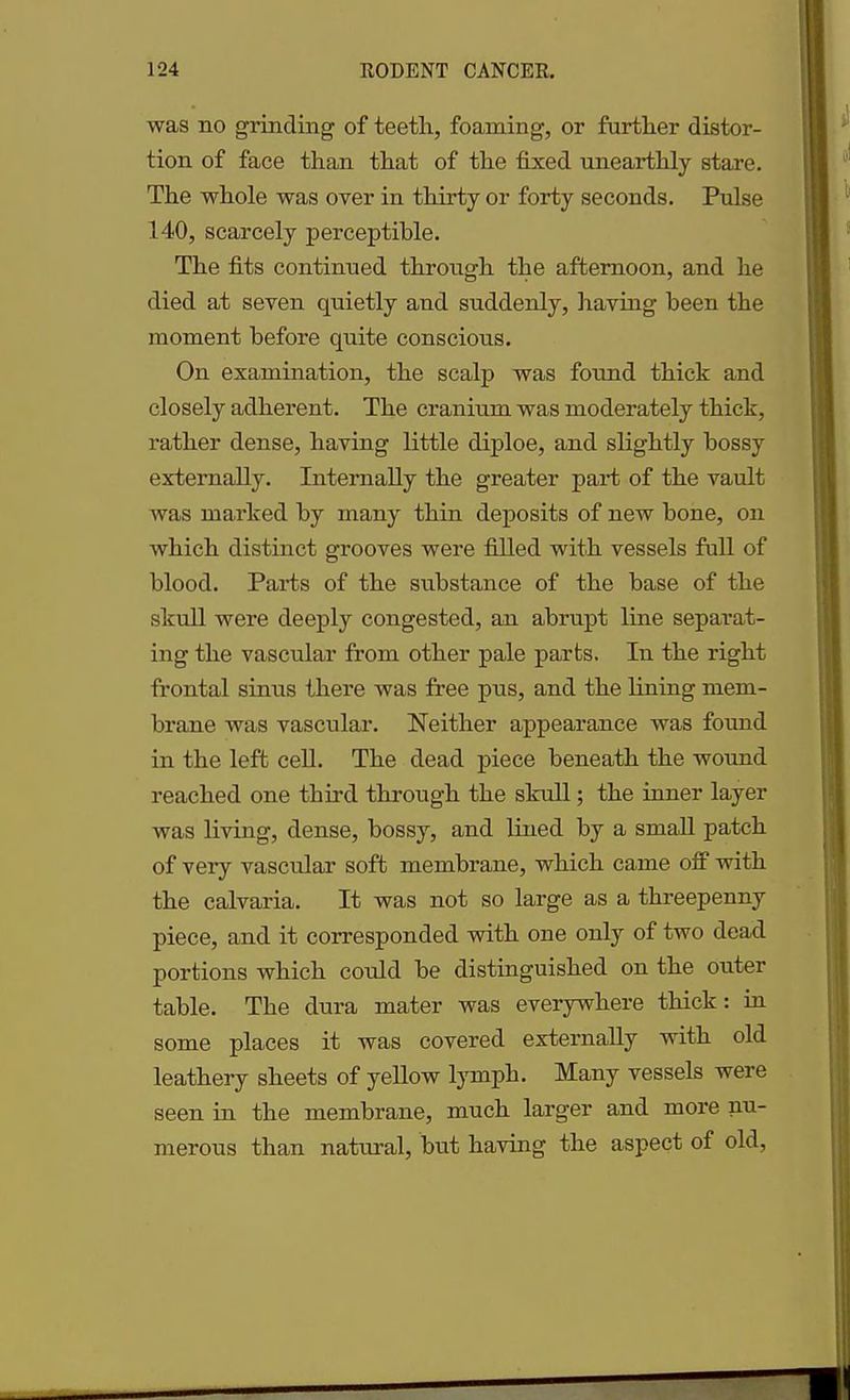 was no grinding of teeth, foaming, or further distor- tion of face than that of the fixed unearthly stare. The whole was over in thirty or forty seconds. Pulse 140, scarcely perceptible. The fits continued through the afternoon, and he died at seven quietly and suddenly, having been the moment before quite conscious. On examination, the scalp was found thick and closely adherent. The cranium was moderately thick, rather dense, having little diploe, and slightly bossy externally. Internally the greater part of the vault was marked by many thin deposits of new bone, on Avhich distinct grooves were filled with vessels full of blood. Parts of the substance of the base of the skull were deeply congested, an abrupt line separat- ing the vascular from other pale parts. In the right frontal sinus there was free pus, and the fining mem- brane was vascular. Neither appearance was found in the left cell. The dead piece beneath the wound reached one third through the skull; the inner layer was living, dense, bossy, and fined by a small patch of very vascular soft membrane, which came off with the calvaria. It was not so large as a threepenny piece, and it corresponded with one only of two dead portions which could be distinguished on the outer table. Tbe dura mater was everywhere thick: in some places it was covered externally with old leathery sheets of yellow lymph. Many vessels were seen in the membrane, much larger and more nu- merous than natural, but having the aspect of old,