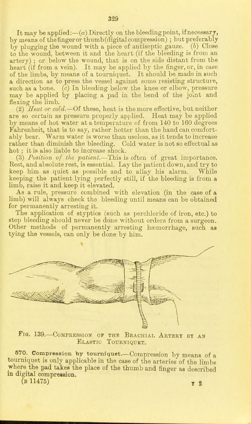 It may be applied:—(«) Directly on tlie bleeding point, if necessary, by means of the finger or thumb (digital compression) ; but preferably by plugging the wound with a piece of antiseptic gauze, (b) Close to the wound, between it and the heart (if the bleeding is from an artery) ; or below the wound, that is on the side distant from the heart (if from a vein). It may be applied by the finger, or, in case of the limbs, by means of a tourniquet. It should be made in such a direction as to press the vessel against some resisting structui'e, such as a bone, (c) In bleeding below the knee or elbow, pressure may be applied by placing a pad in the bend of the joint and flexing the limb. (2) Heat <yr cold.—Of these, heat is the more effective, but neither are so certain as pressure properly applied. Heat may be appHed by means of hot water at a temperature of from 140 to 160 degrees Fahrenheit, that is to say, rather hotter than the hand can comfort- ably bear. Warm water is worse than useless, as it tends to increase rather than diminish the bleeding. Cold water is not so efl'ectual as hot; it is also liable to increase shock. (3) Fosition of the patie7it.—This is often of great importance. Rest, and absolute rest, is essential. Lay the patient down, and try to keep him as quiet as possible and to allay his alarm. While keeping the patient lying perfectly still, if the bleeding is from a limb, raise it and keep it elevated. As a rule, pressure combined with elevation (in the case of a limb) will always check the bleeding until means can be obtained for permanently arresting it. The apphcation of styptics (such as perchloride of iron, etc.) to stop bleeding should never be done without orders from a surgeon. Other methods of permanently arresting hemorrhage, such as tying the vessels, can only be done by him. Fig, 139.—Compression of the Brachial Artkry by an Elastic Tourniquet. 670. Compression by tourniquet.—Compression by means of a tourniquet is only applicable in the case of the arteries of the limbs