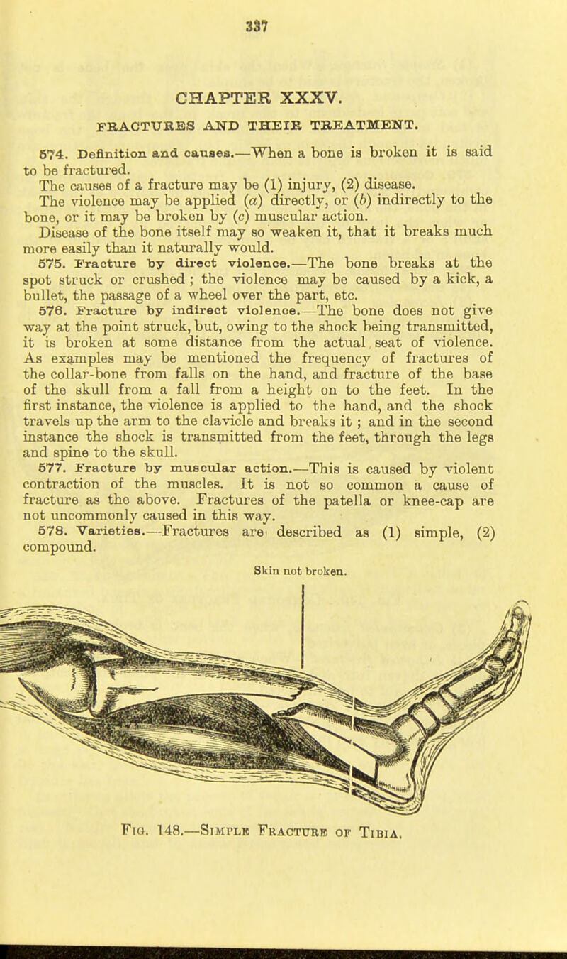 3S7 CHAPTER XXXV. FRACTURES AND THEIR TREATMENT. 674. Definition and causes.—When a bone is broken it is said to be fractured. The Ciiuses of a fracture may be (1) injury, (2) disease. The violence may be applied (a) directly, or (b) indirectly to the bono, or it may be broken by (c) muscular action. Disease of the bone itself may so weaken it, that it breaks much more easily than it naturally would. 575. I'racture toy dii-ect violence.—The bone breaks at the spot struck or crushed; the violence may be caused by a kick, a bullet, the passage of a wheel over the part, etc. 576. Eracture by indirect violence The bone does not give way at the point struck, but, owing to the shock being transmitted, it is broken at some distance from the actual, seat of violence. As examples may be mentioned the frequency of fractures of the collar-bone from falls on the hand, and fracture of the base of the skull from a fall from a height on to the feet. In the first instance, the violence is applied to the hand, and the shock travels up the arm to the clavicle and breaks it ; and in the second instance the shock is transmitted from the feet, through the legs and spine to the skull. 577. Fracture by muscular action.—This is caused by violent contraction of the muscles. It is not so common a cause of fracture aa the above. Fractures of the patella or knee-cap are not uncommonly caused in this way. 578. Varieties.—Fractures arei described as (1) simple, (2) compound. Skin not broken. Fig. 148.—Stmplb Fracturb of Tibia.