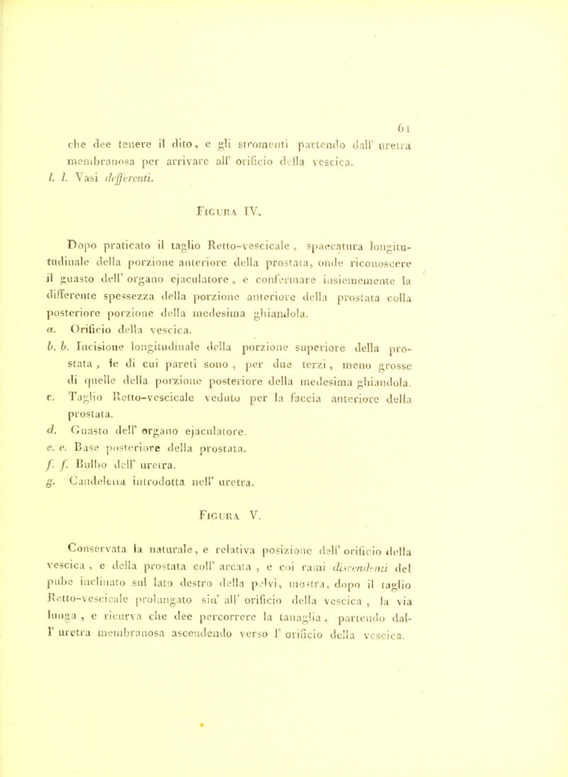 che dee tenere il dito, e gli stromenti partendo dall'ureira membranosa per arrivare alF orlficio della vescica. L L Yasi dejj'erenti. FiGURA IV. Dopo praticato il taglio Retto-vescicale , spaccatnra loiigitu- tudiiiale della porzione anteriore della prostata, onde ricoiioscere il guasto deir organo ejaculatore , e confermare i.isiememente la differente spessezza della porzione anteriore della prostata colla posteriore porzione della riicdesima gliiandola. a. Orificio della vescica. h. h. Incisione longitudinale della porzione superiore della pro- stata, ie di cui pareti sono , per due terzi, meno grosse di fpielle della porzione posteriore della medesima gliiandola, c. Taglio Retto-vescicale vediito per la faccia anteriore della prostata. d. Guasto deir organo ejaculatore. e. e. Base posteriore della prostata. /. /, Bulbo dcir uretra. g. Candelfcua introdotta neU' uretra. Fig LIRA V. Conservata la naturale, e relativa posizione deli'orificio della vescica , e deiia prostata coll' areata , e coi raaii cUscenchnu del pube inclinato sul lato destro della pelvi, nio>tra, dopo il taglio Retto-vescicale prolangato sin alT orificio della vescica , la via lunga , e ricurva che dee percorrere la tanagiia , partendo dal- r uretra meuibranosa ascendeiido verso F orificio della vescica.