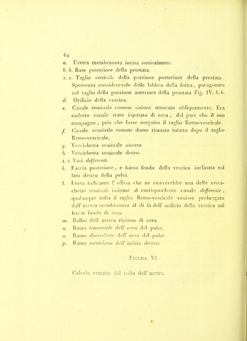 a. Uretra menibraaosa incisa verdcaltnente. h. b. Base posteriore clella prostata, c. c. Tagiio verticale clella porzione posteriore clella prostata . Spessezza consi<lerevole clelle labbra clella ferita, parao;onata col tagiio clella porzione anteriore clella prostata Fig. IV. h. b. d. Orificio della vescica. €. Canale seminale cormine sinistro troncato oblic|uamente. Era codesto canale stato injettato di cera , del pari clie il sixo compagno , pria che fosse esegnito il tagiio Retto-vesc'rcale. f. Canale seminale comune destm riinasto iutatto dopo il tagiio Retto-vescicale. g. Vescichetta seminale sinistra, h. Vescichetta seminale destra. i. L. Vasi defferenti. ; /c. Faccia posteriore , e basso fondo della vescica inclinata sul lato destro della pelvi. /, Linea indicante 1' ofFesa die ne riceverebbe una delle vesci- chette semioali insieme al corrispondente canale defferente , _ qaalumque volta il tagiio Retto-vescicale venisse prolasigato dair uretra membranosa al di la delF orificio della vescica sul basso fondo di cssa. m. Bulbo deir uretra ripieno di cera. n. Ramo trasversale deli' osso del pube. o. Ramo discendente delF osso del pnbe. p. Ramo ascendence deli' iscliio destro. FiGURA VI. Calcolo estratto dal collo dell' uretra.