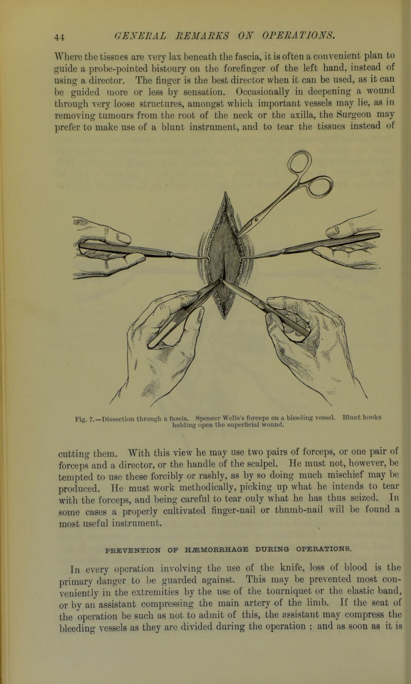 Where the tissues are very lax beneath the fascia, it is often a convenient plan to guide a probe-pointed bistoury on tlie forefinger of the left hand, instead of using a director. The finger is the best director when it can be used, as it can be guided more or less by sensation. Occasionally in deepening a wound through very loose structures, amongst which important vessels may lie, as in removing tumours from the root of the neck or the axilla, the Surgeon may prefer to make use of a blunt instrument, and to tear the tissues instead of Fig. 7.—Dissection through a fascia. S])oiicer Wells's forceps on a bleeding vessel. Blunt liook.s liokling open tlie superllcial wound. cutting them. With this view he may use two pairs of forceps, or one pair of forceps and a director, or the handle of the scalpel. He must not, however, be templed to use these forcibly or rashly, as by so doing much mischief may be produced. He must work methodically, picking up what he intends to tear with the forceps, and being careful to tear only wdiat he has thus seized. In some cases a properly cultivated finger-nail or thumb-nail will be found a most useful instrument. PREVENTION OP HEMORRHAGE DURING OPERATIONS. In every operation involving the use of the knife, loss of blood is the primary danger to be guarded against. This may be prevented most con- veniently in the extremities by the use of the tourniquet or the elastic band, or by an assistant compressing the main artery of the limb. If the seat of the operation be such as not to admit of this, the assistant may compress the bleeding vessels as they arc divided during the operation ; and as soon as it is