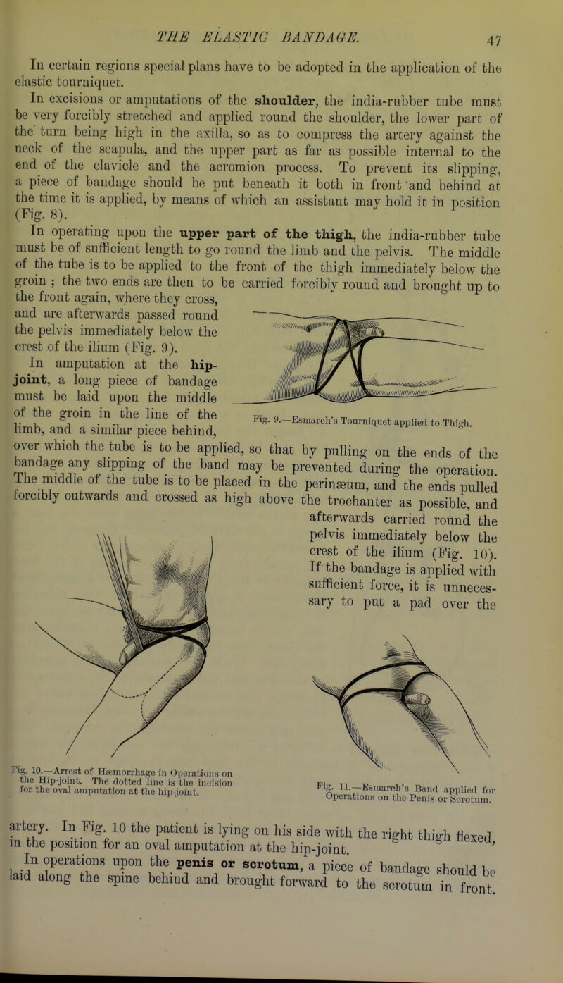 THE ELASTIC BANDAGE. In certain regions special plans have to be adopted in the application of the elastic tourniquet. In excisions or amputations of the shoulder, the india-rubber tube must be very forcibly stretched and applied round the shoulder, the lower part of the' turn being high in the axilla, so as to compress the artery against the neck of the scapula, and the upper part as far as possible internal to the end of the clavicle and the aci-omion process. To prevent its slipping, a piece of bandage should be put beneath it both in frout and behind at the time it is applied, by means of which an assistant may hold it in position (Fig. 8). In operating upon the upper part of the thigh, the india-rubber tube must be of sufficient length to go round the limb and the pelvis. The middle of the tube is to be applied to the front of the thigh immediately below the groin ; the two ends are then to be carried forcibly round and brought up to the front again, where they cross, and are after\vards passed round the pelvis immediately below the crest of the ilium (Fig. 9). In amputation at the hip- joint, a long piece of bandage must be laid upon the middle of the groin in the line of the limb, and a similar piece behind, over which the tube is to be applied, so that by pulling on the ends of the bandage any slippmg of the band may be prevented during the operation The middle of the tube is to be placed in the peringeum, and the ends pulled forcibly outwards and crossed as high above the trochanter as possible, and afterwards carried round the pelvis immediately below the crest of the ilium (Fig. 10), If the bandage is applied with sufficient force, it is unneces- sary to put a pad over the Fig. 9.—Esmarcli's Tourniquet applied to Thigh. Fig 10.—Arrest of Hemorrhage in Oporations on the Hip-joint. Tlie dotted line is tlie incision lor the oval amputation at the hip-joint. Fig. 11.—Esinarch's Band applied for Operations on tlie Penis or Scrotum. artery. In Fig 10 the patient is lying on his side with the right thio-h flexed m the position for an oval amputation at the hip-joint In operations upon the penis or scrotum, a piece of bandage should be laid along the spme behind and brought forward to the scrotum in front!