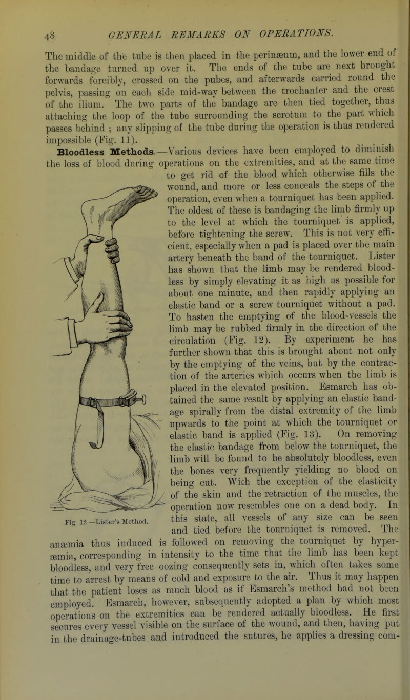 The middle of the tube is then placed in the perinseum, and the lower end of the bandage turned up over it. The ends of the tube are next brought forwards forcibly, crossed on the pubes, and afterwards carried round the pelvis, passing on each side mid-way between the trochanter and the crest of the ilium. The two parts of the bandage are then tied together, thus attaching the loop of the tube surrounding the scrotum to the part whicli passes behind ; any slipping of the tube during the operation is thus rendered impossible (Fig. 11). Bloodless Methods.—Various devices have been employed to diminish the loss of blood during operations on the extremities, and at the same time to get rid of the blood which otherwise fills the wound, and more or less conceals the steps of the operation, even when a tourniquet has been applied. The oldest of these is bandaging the limb firmly up to the level at which the tourniquet' is applied, befoi-e tightening the screw. This is not very effi- cient, especially when a pad is placed over the main artery beneath the band of the tourniquet. Lister has shown that the limb may be rendered blood- less by simply elevating it as high as possible for about one minute, and then rapidly applying an elastic band or a screw tourniquet without a pad. To hasten the emptying of the blood-vessels the limb may be rubbed firmly in the direction of the circulation (Fig. 12). By experiment he has further shown that this is brought about not only by the emptying of the veins, but by the contrac- tion of the arteries whicli occurs when the limb is placed in the elevated position. Esmarch has ob- tained the same result by applying an elastic band- age spirally from the distal extremity of the limb upwards to the point at which the tourniquet or elastic band is apphed (Fig. 13). On removing the elastic bandage from below the tourniquet, the limb will be found to be absolutely bloodless, even the bones very frequently yielding no blood on being cut. With the exception of the elasticity of the skin and the retraction of the muscles, the operation now resembles one on a dead body. In this state, all vessels of any size can be seen and tied before the tourniquet is removed. The anfEmia thus induced is followed on removing the tourniquet by hyper- £emia, corresponding in intensity to the time that the limb has been kept bloodless, and very free oozing consequently sets in, which often takes some time to arrest by means of cold and exposure to the air. Thus it may happen that the patient loses as much blood as if Esmarch's method had not been employed. Esmarch, however, subsequently adopted a plan by which most operations on the extremities can be rendered actually bloodless. He first secures every vessel visible on the surface of the wound, and then, having put in the drainage-tubes and introduced the sutures, he applies a dressing com- Fiff 12 —Lister's Method.
