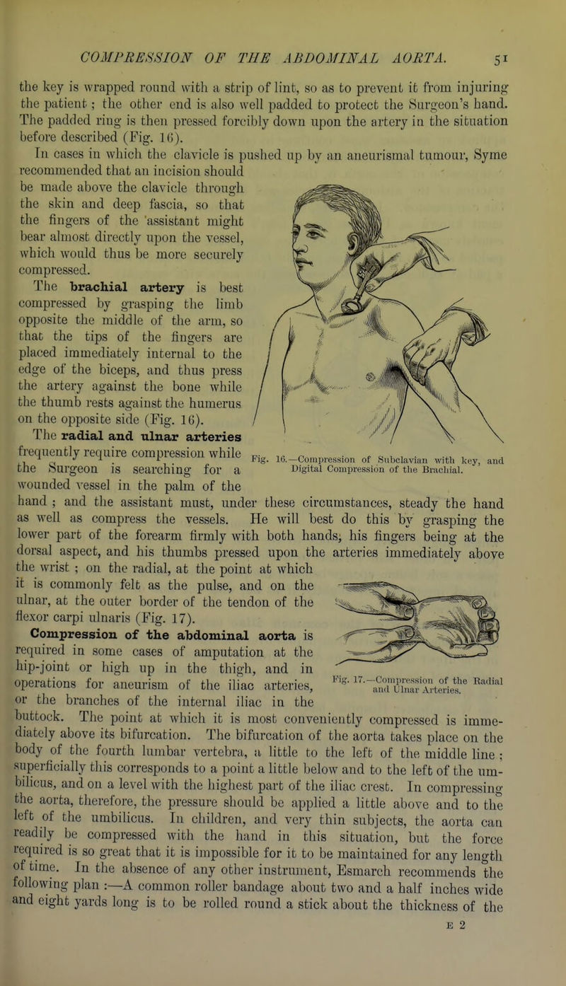 10.—Compression of Subclavian witli key, and Digital Compression of the Bracliial. the key is wrapped round with a strip of lint, so as to prevent it from injuring the patient; the other end is also well padded to protect the Surgeon's hand. The padded ring is then pressed forcibly down upon the artery in the situation before described (Fig. 1(5). In cases in which the clavicle is pushed up by an aneurismal tumour, Syme recommended that an incision should be made above the clavicle throuo-h the skin and deep fascia, so that the fingers of the 'assistant might bear almost directly upon the vessel, which would thus be more securely compressed. The brachial artery is best compressed by grasping the limb opposite the middle of the arm, so that the tips of the fingers are placed immediately internal to the edge of the biceps, and thus press the artery against the bone while the thumb rests against the humerus on the opposite side (Fig. 16). The radial and ulnar arteries frequently require compression while the Surgeon is searching for a wounded vessel in the palm of the hand ; and the assistant must, under these circumstances, steady the hand as well as compress the vessels. He will best do this by grasping the lower part of the forearm firmly with both hands, his fingers being at the dorsal aspect, and his thumbs pressed upon the arteries immediately above the wrist ; on the radial, at the point at which it is commonly felt as the pulse, and on the ulnar, at the outer border of the tendon of the flexor carpi ulnaris (Fig. 17). Compression of the abdominal aorta is required in some cases of amputation at the hip-joint or high up in the thigh, and in operations for aneurism of the iliac arteries, or the branches of the internal iliac in the buttock. The point at which it is most conveniently compressed is imme- diately above its bifurcation. The bifurcation of the aorta takes place on the body of the fourth lumbar vertebra, a little to the left of the middle line ; superficially this corresponds to a point a little below and to the left of the um- bihcus, and on a level with the highest part of the ihac crest. In compressing the aorta, therefore, the pressure should be applied a little above and to the left of the umbilicus. In children, and very thin subjects, the aorta can readily be compressed with the hand in this situation, but the force required is so great that it is impossible for it to be maintained for any length of time. In the absence of any other instrument, Esmarch recommends the following plan A common roller bandage about two and a half inches wide and eight yards long is to be rolled round a stick about the thickness of the E 2 Fig. 17.—Compression of the Radial and Ulnar Arteries.