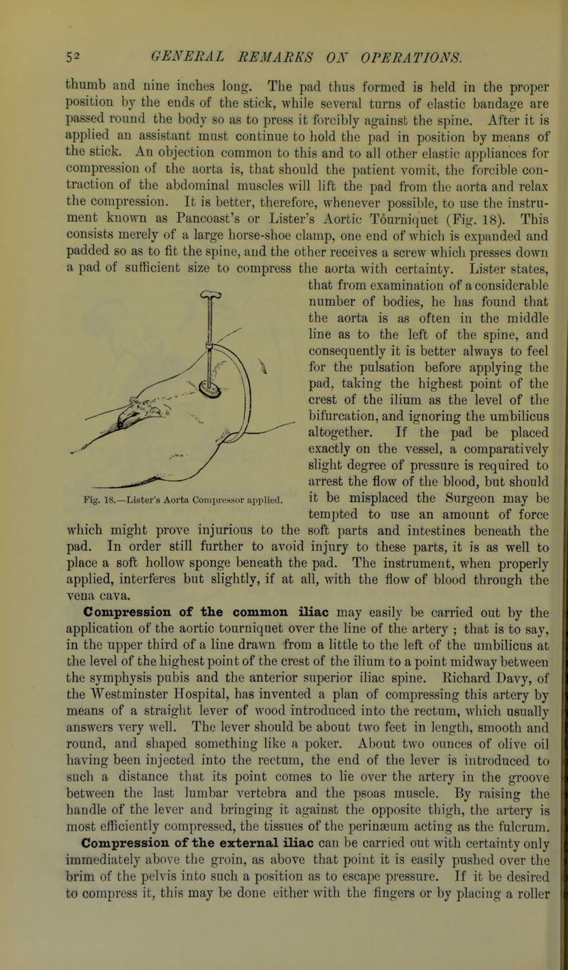 thumb and nine inches long. The pad thus formed is held in the proper position by the ends of the stick, while several turns of elastic bandage are passed round the body so as to press it forcibly against the spine. After it is applied an assistant must continue to hold the pad in position by means of the stick. An objection common to this and to all other elastic appliances for compression of the aorta is, that should the patient vomit, the forcible con- traction of the abdominal muscles will lift the pad from the aorta and relax the compression. It is better, therefore, whenever possible, to use the instru- ment known as Pancoast's or Lister's Aortic Tournicjuet (Fig. 18). This consists merely of a large horse-shoe clamp, one end of which is expanded and padded so as to fit the spine, and the other receives a screw which presses down a pad of sufficient size to compress the aorta with certainty. Lister states, that from examination of a considerable number of bodies, he has found that the aorta is as often in the middle hne as to the left of the spine, and consequently it is better always to feel for the pulsation before applying the pad, taking the highest point of the crest of the ilium as the level of the bifurcation, and ignoring the umbihcus altogether. If the pad be placed exactly on the vessel, a comparatively slight degree of pressure is required to arrest the flow of the blood, but should Fig. 18.—Lister's Aorta Compressor applied, it be misplaced the Surgeon may be tempted to use an amount of force which might prove injurious to the soft parts and intestines beneath the pad. In order still further to avoid injury to these parts, it is as well to place a soft hollow sponge beneath the pad. The instrument, when properly applied, interferes but slightly, if at all, with the flow of blood through the vena cava. Compression of the common iliac may easily be carried out by the application of the aortic tourniquet over the line of the artery ; that is to say, in the upper third of a line drawn from a little to the left of the umbilicus at the level of the highest point of the crest of the ilium to a point midway between the symphysis pubis and the anterior superior iliac spine. Richard Davy, of the Westminster Hospital, has invented a plan of compressing this artery by means of a straight lever of wood introduced into the rectum, which usually answers very well. The lever should be about two feet in length, smooth and round, and shaped something like a poker. About two ounces of olive oil having been injected into the rectum, the end of the lever is introduced to such a distance that its point comes to lie over the artery in the groove i between the last lumbar vertebra and the psoas muscle. By raising the \ handle of the lever and bringing it against the opposite thigh, the artery is most efficiently compressed, the tissues of the perinaeum acting as the fulcrum. Compression of the external iliac can be carried out with certainty only immediately above the groin, as above that point it is easily pushed over the ' brim of the pelvis into such a position as to escape pressure. If it be desired i to compress it, this may be done either with the fingers or by placing a roller