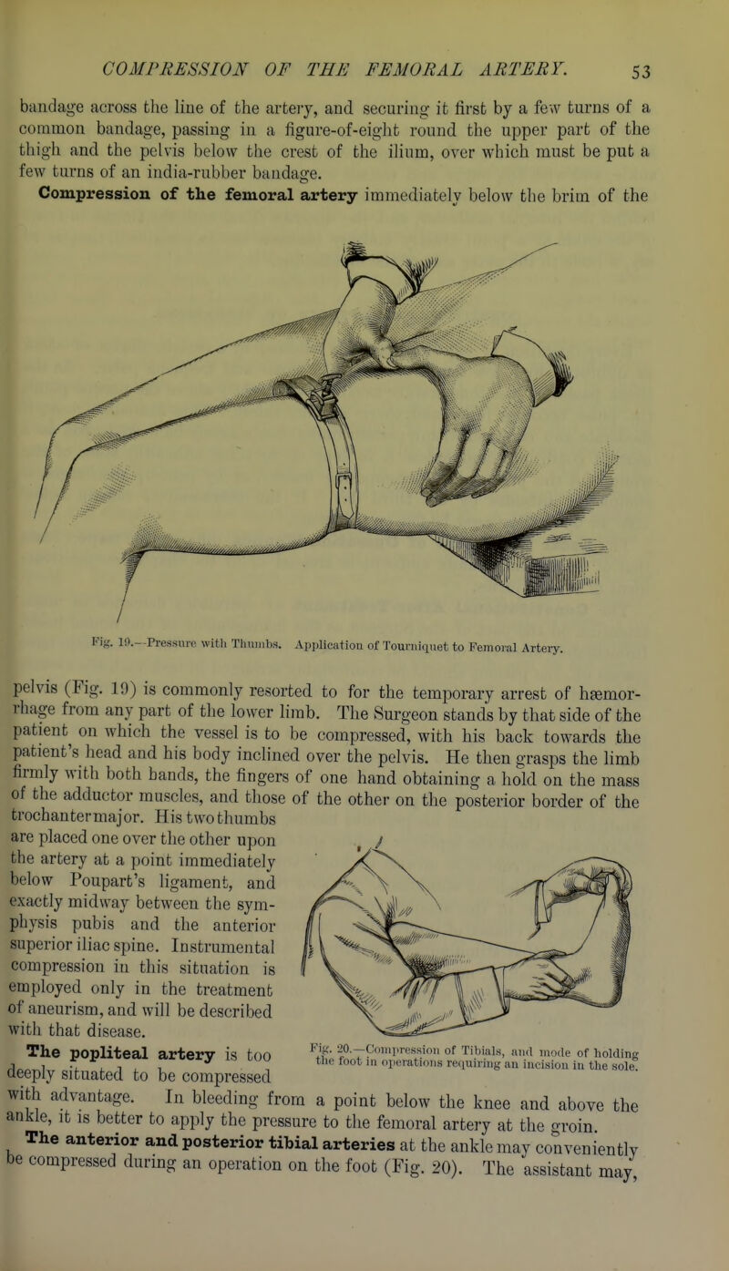 bandage across the line of the artery, and securing it first by a few turns of a common bandage, passing in a figure-of-eight round the upper part of the thigh and the pelvis below the crest of the ilium, over which must be put a few turns of an india-rubber bandage. Compression of the femoral artery immediately below the brim of the Pif,'. 10.--Pressure with Thumbs. Application of Tourniciuet to Femoral Artery. pelvis (Fig. 19) is commonly resorted to for the temporary arrest of hemor- rhage from any part of the lower limb. The Surgeon stands by that side of the patient^ on which the vessel is to be compressed, with his back towards the patient's head and his body inclined over the pelvis. He then grasps the limb firmly with both bands, the fingers of one hand obtaining a hold on the mass of the adductor muscles, and those of the other on the posterior border of the trochantermajor. His two thumbs are placed one over the other upon the artery at a point immediately below Poupart's ligament, and exactly midway between the sym- physis pubis and the anterior superior iliac spine. Instrumental compression in this situation is employed only in the treatment of aneurism, and will be described with that disease. The popliteal artery is too deeply situated to be compressed with advantage. In bleeding from a point below the knee and above the ankle, it is better to apply the pressure to the femoral artery at the groin. The anterior and posterior tibial arteries at the ankle may conveniently be compressed during an operation on the foot (Fig. 20). The assistant may '-^O-—t'cinp'-essioii of Tibiiils, and mode of holding the loot in ojierations reijuiring an incision in the sole.