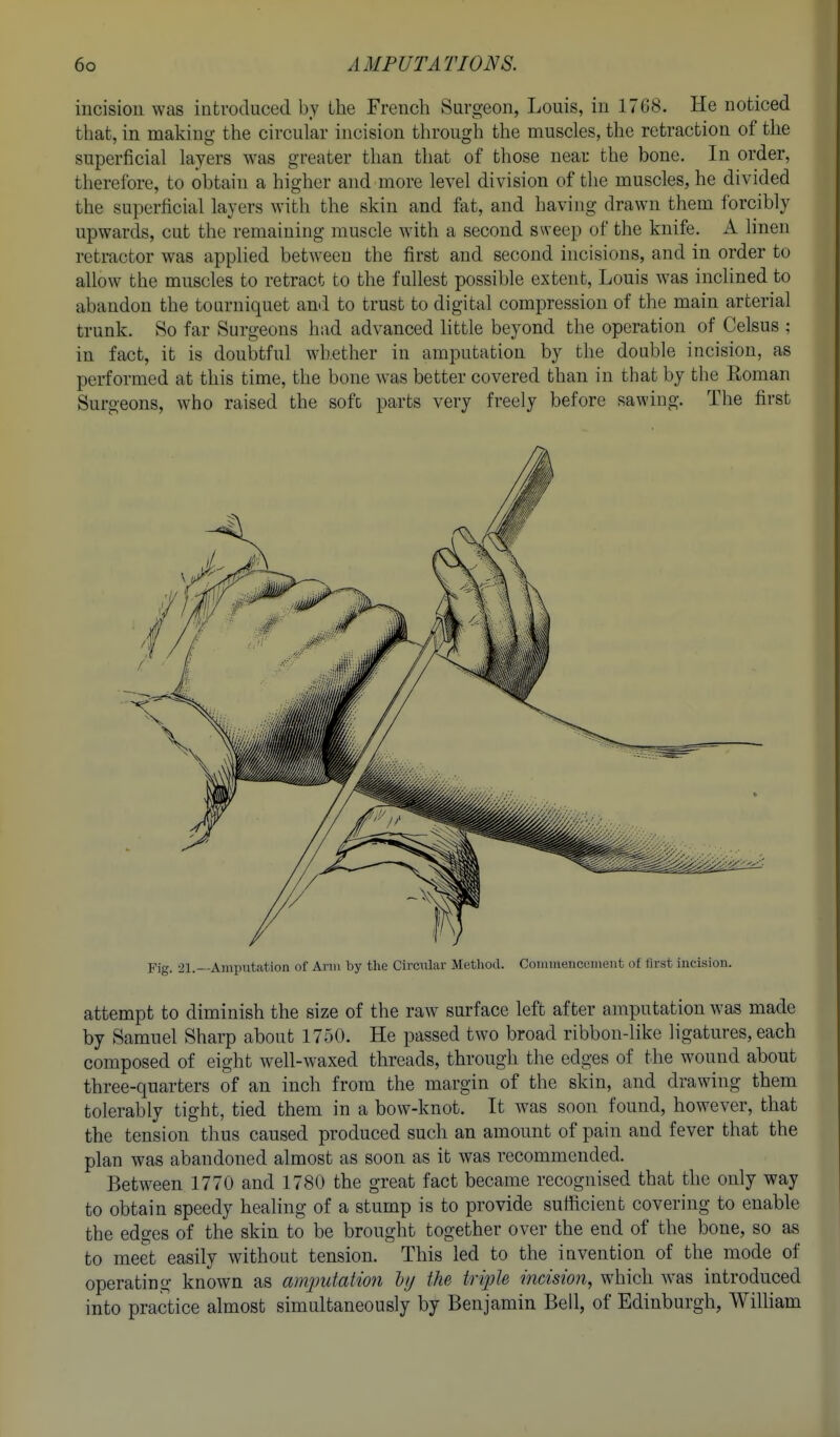 incision was introduced by the French Surgeon, Louis, in 1768. He noticed that, in makinir the circular incision through the muscles, the retraction of the superficial layers was greater than that of those near the bone, in order, therefore, to obtain a higher and more level division of the muscles, he divided the superficial layers with the skin and fat, and having drawn them forcibly upwards, cut the remaining muscle with a second sweep of the knife. A linen retractor was appUed between the first and second incisions, and in order to allow the muscles to retract to the fullest possible extent, Louis was inclined to abandon the tourniquet and to trust to digital compression of the main arterial trunk. So far Surgeons had advanced little beyond the operation of Celsus ; in fact, it is doubtful whether in amputation by the double incision, as performed at this time, the bone was better covered than in that by the Roman Surgeons, who raised the soft parts very freely before sawing. The first Fig. 21.—Amputation of Ann by the Circular Method. Coiiiiiienccineiit of first incision. attempt to diminish the size of the raw surface left after amputation was made by Samuel Sharp about 1750. He passed two broad ribbon-like ligatures, each composed of eight well-waxed threads, through the edges of the wound about three-quarters of an inch from the margin of the skin, and drawing them tolerably tight, tied them in a bow-knot. It was soon found, however, that the tension thus caused produced such an amount of pain and fever that the plan was abandoned almost as soon as it was recommended. Between 1770 and 1780 the great fact became recognised that the only way to obtain speedy healing of a stump is to provide sufficient covering to enable the edges of the skin to be brought together over the end of the bone, so as to meet easily without tension. This led to the invention of the mode of operating known as amputation lij the triple incision, which Avas introduced into practice almost simultaneously by Benjamin Bell, of Edinburgh, WiUiam