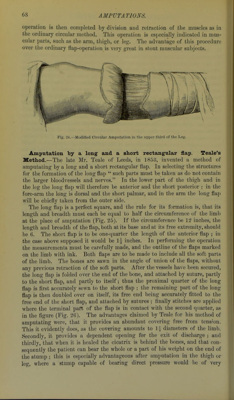operation is then completed by division and retraction of the muscles as in the ordinary circular method. This operation is especially indicated in mus- cular parts, such as the arm, thigh, or leg. The advantage of this procedure over the ordinary flap-operation is very great in stout muscular subjects. Fig. 24.—Modified Circular Amputation in tlio third of the Leg. Amp-utation by a long and a short rectangular flap. Teale's Method.—The late Mr. Teale of Leeds, in 1858, invented a method of amputating by a long and a short rectangular flap. In selecting the structures for the formation of the long flap  such parts must be taken as do not contain the larger bloodvessels and nerves. In the lower part of the thigh and in the leg the long flap will therefore be anterior and the short posterior : in the fore-arm the long is dorsal and the short palmar, and in the arm the long flap will be chiefly taken from the outer side. The long flap is a perfect square, and the rule for its formation is, that its length and breadth must each be equal to half the circumference of the limb at the place of amputation (Fig. 25). If the circumference be 12 inches, the length and breadth of the flap, both at its base and at its free extremity, should be 6. The short flap is to be one-quarter the length of the anterior flap ; in the case above supposed it would be 1\ inches. In performing the operation the measurements must be carefully made, and the outline of the flaps marked on the Hmb with ink. Both flaps are to be made to include all the soft parts of the limb. The bones are sawn in the angle of union of the flaps, without any previous retraction of the soft parts. After the vessels ha^•e been secured, the long flap is folded over the end of tlie bone, and attached by suture, partly to the short flap, and partly to itself; thus the proximal quarter of the long flap is first accurately sewn to the short flap ; the remaining part of the long flap is then doubled over on itself, its free end being accurately fitted to the free end of the short flap, and attached by sutures ; finally stitches are applied where the terminal part of the flap is in contact with the second quarter, as in the figure (Fig. 26). The advantages claimed by Teale for his method of amputating were, that it provides an abundant covering free from tension. This it evidently does, as the covering amounts to 1|- diameters of the limb. Secondly, it provides a dependent opening for the exit of discharge ; and thirdly, that when it is healed the cicatrix is behind the bones, and that con- sequently the patient can bear the whole or a part of his weight on the end of the stump ; this is especially advantageous after amputation in the thigh oi- leg, where a stump capable of bearing direct pressure would be of very