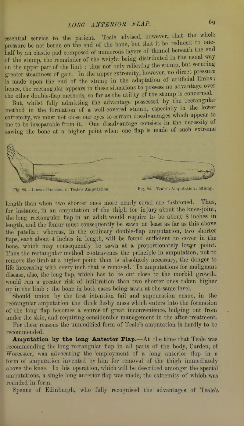LONG ANTERIOR FLAP. essential service to the patient. Teale advised, however, that the whole pressure be not borne on the end of the bone, but that it be reduced to one- half by an elastic pad composed of numerous layers of flannel beneath the end of the stump, the remainder of the weight being distributed m the usual way on the upper part of the limb : thus not only relieving the stump, but securing greater steadiness of gait. In the npper extremity, however, no direct pressure is made upon the end of the stump in the adaptation of artificial limbs ; hence, the rectangular appears in these situations to possess no advantage over the other double-flap methods, so far as the utiHty of the stump is concerned. But, whilst fully admitting the advantage possessed by the rectangular method in the formation of a well-covered stump, especially in the lower extremity, we must not close our eyes to certain disadvantages which appear to me to be inseparable from it. One disadvantage consists in the necessity of sawing the bone at a higher point when one flap is made of such extreme Fig. -'o.--Lilies of Incision in Tealc's Amputation. Kig. 2i).—Teale's Amputation : Stump. length than when two shorter ones more nearly equal are fashioned. Thus, for instance, in an amputation of the thigh for injury about the knee-joint, the long rectangular flap in an adult would require to be about 8 inches in length, and the femur must consequently be sawn at least as far as this above the patella : whereas, in the ordinary double-flap amputation, two shorter flaps, each about 4 inches in length, will be found sufficient to cover in the bone, which may consequently be sawn at a proportionately low^r point. Thus the rectangular method contravenes the principle in amputation, not to remove the limb at a higher point than is absolutely necessary, the danger to life increasing with every inch that is removed. In amputations for malignant disease, also, the long flap, which has to be cut close to the morbid growth, would run a greater risk of infiltration than two shorter ones taken higher up in the limb : the bone in both cases being sawn at the same level. Should union by the first intention fail and suppuration ensue, in the rectangular amputation the thick fleshy mass which enters into the formation of the long flap becomes a source of great inconvenience, bulging out from under the skin, and requiring considerable management in the after-treatment. For these reasons the unmodified form of Teale's amputation is hardly to be recommended. Amputation by the long Anterior Flap.—At the time that Teale was i-ecommending the long rectangular flap in all parts of the body, Garden, of Worcester, w-as advocating the employment of a long anterior flap in a form of amputation invented by him for removal of the thigh immediately above the knee. In his operation, which will be des(;ribed amongst the special amputations, a single long anterior flap was made, the extremity of which was rounded in form. Spence of Edinburgh, who fully recognised the advantages of Teale's