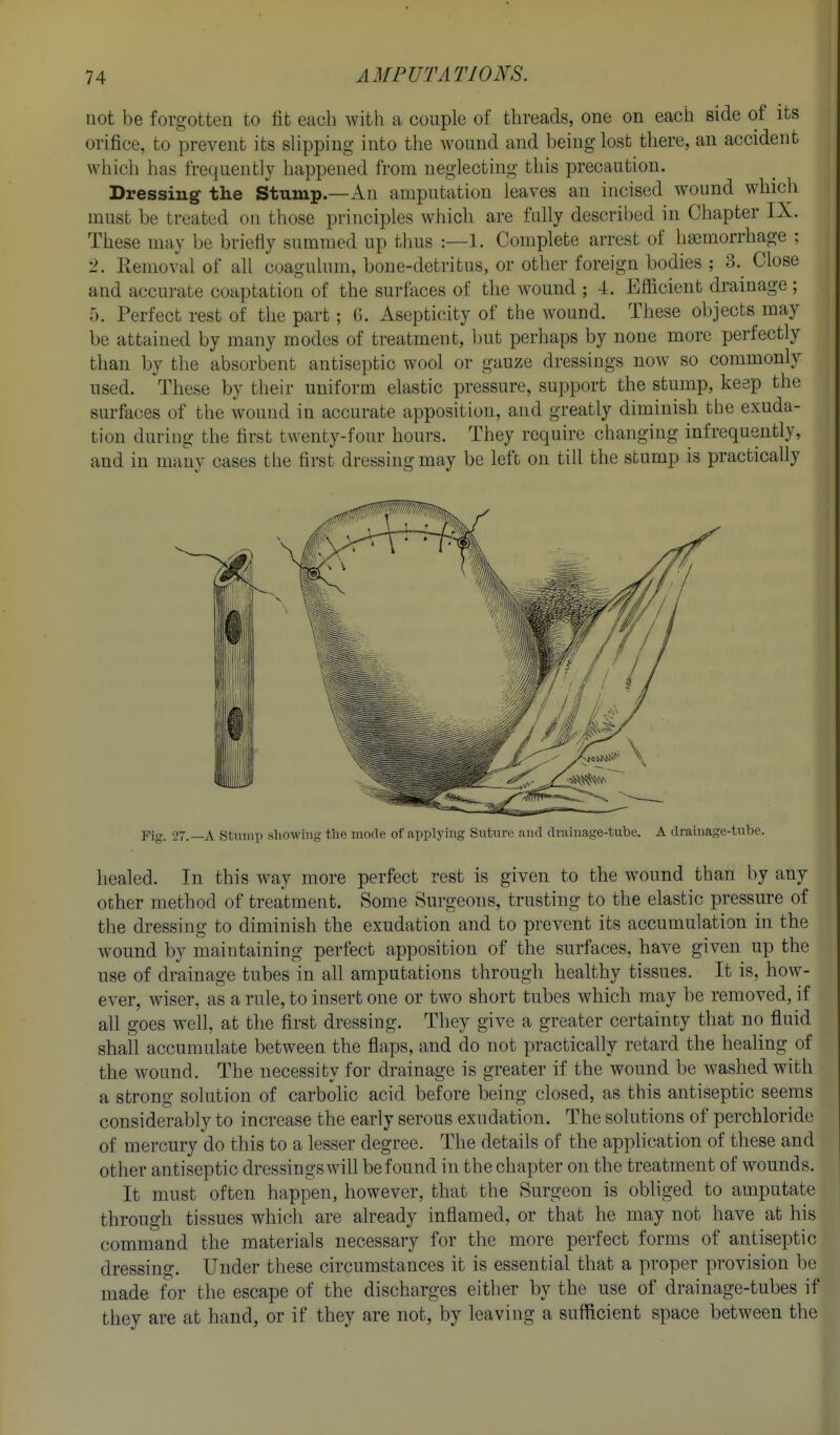 not be forgotten to fit each with a couple of threads, one on each side of its orifice, to prevent its sUpping into the wound and being lost there, an accident which has frequently happened from neglecting this precaution. Dressing the Stump.—An amputation leaves an incised wound which must be treated on those principles which are fully described in Chapter IX. These may be briefly summed up thus :—1. Complete arrest of haemorrhage ; 2. Removal of all coagulum, bone-detritus, or other foreign bodies ; 3. Close and accurate coaptation of the surfaces of the wound ; 4. Efficient drainage ; 5. Perfect rest of the part; G. Asepticity of the wound. These objects may be attained by many modes of treatment, but perhaps by none more perfectly than by the absorbent antiseptic wool or gauze dressings now so commonly used. These by their uniform elastic pressure, support the stump, keep the surfaces of the wound in accurate apposition, and greatly diminish the exuda- tion during the first twenty-four hours. They require changing infrequently, and in many cases the first dressing may be left on till the stump is practically Fig. 27.—A Stmiip showing the mode of applying Suture and drainage-tube. A drainage-tube. healed. In this way more perfect rest is given to the wound than by any other method of treatment. Some Surgeons, trusting to the elastic pressure of the dressing to diminish the exudation and to prevent its accumulation in the wound by maintaining perfect apposition of the surfaces, have given up the use of drainage tubes in all amputations through healthy tissues. It is, how- ever, wiser, as a rule, to insert one or two short tubes which may be removed, if all goes well, at the first dressing. They give a greater certainty that no fluid shall accumulate between the flaps, and do not practically retard the healing of the wound. The necessity for drainage is greater if the wound be washed with a strong solution of carbolic acid before being closed, as this antiseptic seems considerably to increase the early serous exudation. The solutions of perchloride of mercury do this to a lesser degree. The details of the application of these and other antiseptic dressings will be found in the chapter on the treatment of wounds. It must often happen, however, that the Surgeon is obliged to amputate through tissues which are already inflamed, or that he may not have at his command the materials necessary for the more perfect forms of antiseptic dressing. Under these circumstances it is essential that a proper provision be made for the escape of the discharges either by the use of drainage-tubes if they are at hand, or if they are not, by leaving a sufficient space between the