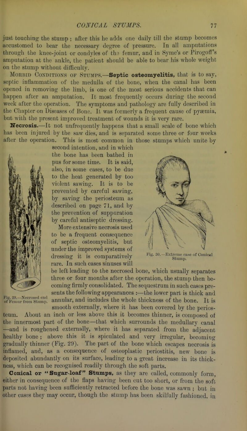 just touching the stump ; after this he adds one daily till the stump becomes accustomed to bear the necessary degree of pressure. In all amputations through the knee-joint or condyles of thj femur, and in Synie's or Pirogoff's amputation at the ankle, the patient should be able to bear his whole weight on the stump without difficulty. Morbid Conditions of Stumps.—Septic osteomyelitis, that is to say, septic inflammation of the medulla of the bone, when the canal has been opened in removing the limb, is one of the most serious accidents that can happen after an amputation. It most frequently occurs during the second week after the operation. The symptoms and pathology are fully described in the Chapter on Diseases of Bone. It was formerly a frequent cause of pyaemia, but with the present im.proved treatment of wounds it is very rare, Ifecrosis.—It not unfrequently happens that a small scale of bone which has been injured by the saw dies, and is separated some three or four weeks after the operation. This is most common in those stumps which unite by second intention, and in which the bone has been bathed in pus for some time. It is said, also, in some cases, to be due to the heat generated by too violent sawing. It is to be prevented by careful sawing, by saving the periosteum as described on page 71, and by the prevention of suppuration by careful antiseptic dressing. More extensive necrosis used to be a frequent consequence of septic osteomyelitis, but under the improved systems of dressing it is comparatively rare. In such cases sinuses will be left leading to the necrosed bone, which usually separates three or four months after the operation, the stump then be- coming firmly consolidated. The sequestrum in such cases pre- sents the following appearances :—the lower part is thick and annular, and includes the whole thickness of the bone. It is smooth externally, where it has been covered by the perios- teum. About an inch or less above this it becomes thinner, is composed of the innermost part of the bone—that which surrounds the medullary canal —and is roughened externally, where it has separated from the adjacent healthy bone ; above this it is spiculated and very irregular, becoming gradually thinner (Fig. 29). The part of the bone which escapes necrosis is inflamed, and, as a consequence of osteoplastic periostitis, new bone is deposited abundantly on its surface, leading to a great increase in its thick- ness, which can be recognised readily through the soft parts. Conical or Sugar-loaf Stumps, as they are called, commonly form, either in consequence of the flaps having been cut too short, or from the soft parts not having been sufficiently retracted before the bone was sawn ; but in other cases they may occur, though the stump has been skilfully fashioned, in FiL'. 30.- -Extreiue I'ase of Conical Stuinp. l''ig. 20.—Necrosied end of Fouur from Stump.