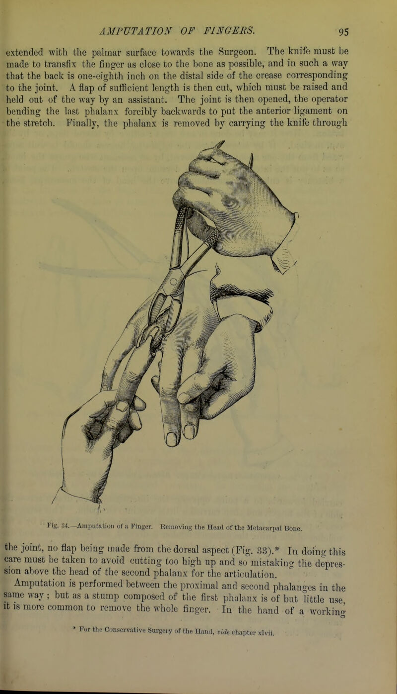 extended with the pahnar surface towards the Surgeon. The knife must be made to transfix the finger as close to the bone as possible, and in such a way that the back is one-eighth inch on the distal side of the crease corresponding to the joint. A flap of sufficient length is then cat, which must be raised and held out of the way by an assistant. The joint is then opened, the operator bending the last phalanx forcibly backwards to put the anterior ligament on the stretch. Finally, the phalanx is removed by carrying the knife through Fig. 04.—Amputation of a Finger. Removing the Head of the Metacarpal Bone. the joint, no flap being made from the dorsal aspect (Fig. 33).* In doino- this care must be taken to avoid cutting too high up and so mistaking the depres- sion above the head of the second phalanx for the articulation. Amputation is performed between the proximal and second phalanges in the same way ; but as a stump composed of the first phalanx is of but little use It IS more common to remove the whole finger. In the hand of a workinci » For the Conservcative Surgery of the Hand, vide chapter xlvii.