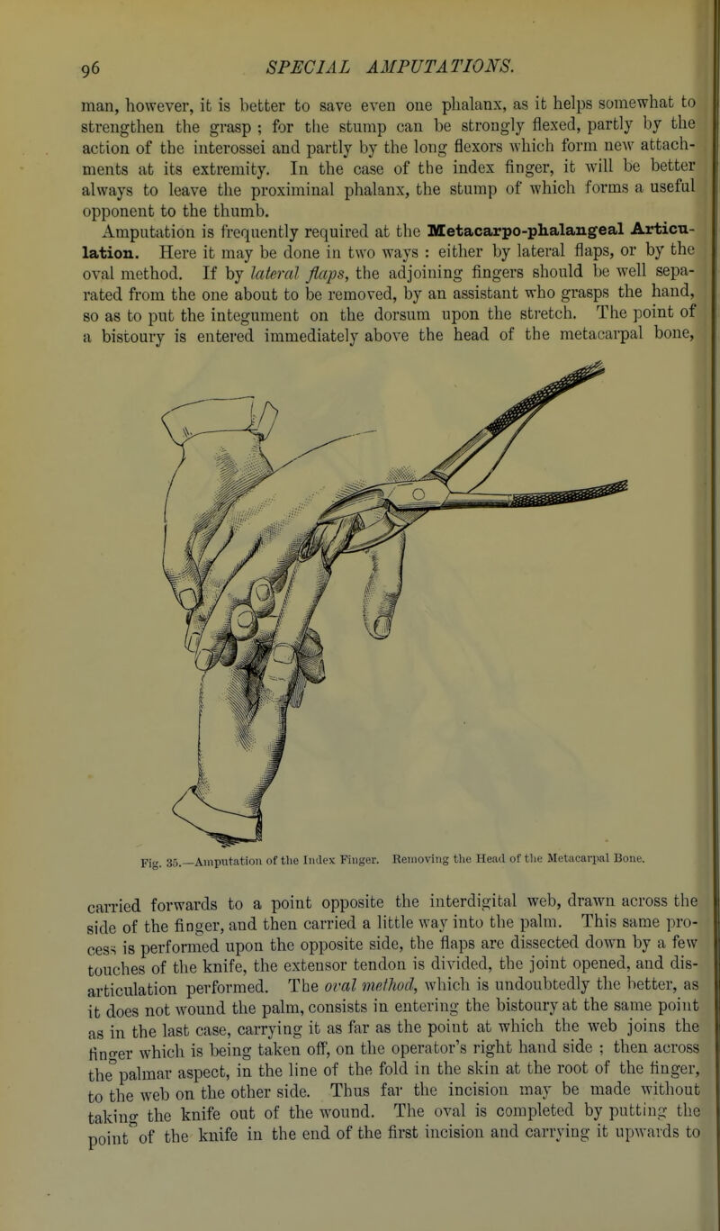 man, however, it is better to save even one phalanx, as it helps somewhat to strengthen the grasp ; for the stump can be strongly flexed, partly by the action of the interossei and partly by the long flexors which form new attach- ments at its extremity. In the case of the index finger, it will be better always to leave the proximinal phalanx, the stump of which forms a useful opponent to the thumb. Amputation is frequently required at the Metacarpo-phalangeal Articu- lation. Here it may be done in two ways : either by lateral flaps, or by the oval method. If by lateral flaps, the adjoining fingers should be well sepa- rated from the one about to be removed, by an assistant who grasps the hand, so as to put the integument on the dorsum upon the stretch. The point of a bistoury is entered immediately above the head of the metacarpal bone, Fig. 35.—Amputation of tlie Index Finger. Removing the Head of the Metacarpal Bone. carried forwards to a point opposite the interdigital web, drawn across the side of the finger, and then carried a little way into the palm. This same pro- cess is performed upon the opposite side, the flaps are dissected down by a few touches of the knife, the extensor tendon is divided, the joint opened, and dis- articulation performed. The oval method, which is undoubtedly the better, as it does not wound the palm, consists in entering the bistoury at the same point as in the last case, carrying it as far as the point at which the web joins the finder which is being taken off, on the operator's right hand side ; then across the°palmar aspect, in the line of the fold in the skin at the root of the finger, to the web on the other side. Thus far the incision may be made without takino- the knife out of the wound. The oval is completed by putting the point^of the knife in the end of the first incision and carrying it upwards to I