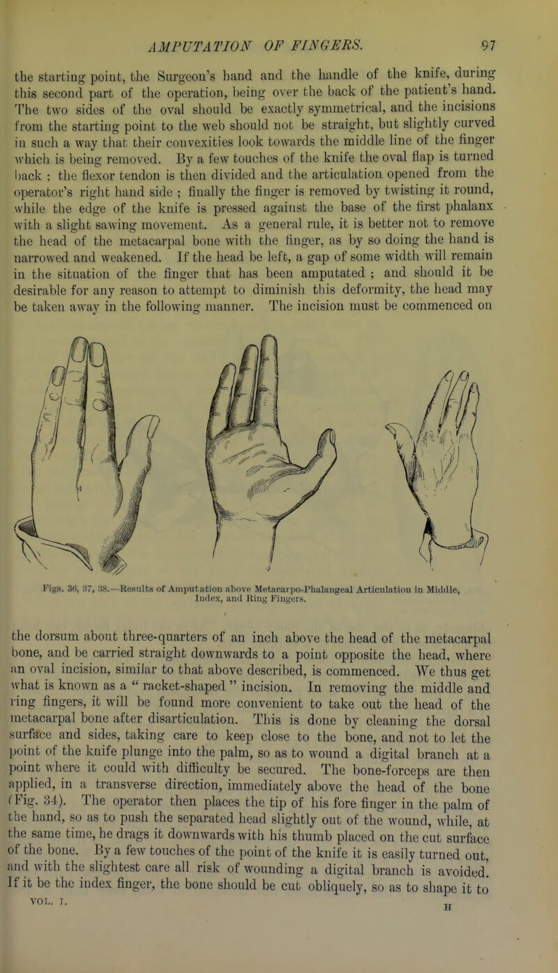 the starting poiut, the Surgeon's hand and the handle of the knife, during this second part of the operation, being over the back of the patient's hand. 'I'he two sides of the oval should be exactly symmetrical, and the incisions from the starting point to the web should not be straight, but slightly curved in such a way that their convexities look towards the middle line of the finger ^vhich is being removed. By a few touches of the knife the oval flap is turned back ; the flexor tendon is then divided and the articulation opened from the operator's right hand side ; finally the finger is removed by twisting it round, while the edge of the knife is pressed against the base of the first phalanx with a slight sawing movement. As a general rule, it is better not to remove the head of the metacarpal bone with the finger, as by so doing the hand is narrowed and weakened. If the head be left, a gap of some width will remain in the situation of the finger that has been amputated ; and should it be desirable for any reason to attempt to diminish this deformity, the head may be taken away in the following manner. The incision must be commenced on Figs. 3(3, 37, 38.—Results of Amputation above Metacaipo-Phalangeal Articulation in Middle, Index, and Ring Fingers. the dorsum about three-quartei's of an inch above the head of the metacarpal bone, and be carried straight downwards to a point opposite the head, where an oval incision, similar to that above described, is commenced. We thus get what is known as a  racket-shaped  incision. In removing the middle and ring fingers, it will be found more convenient to take out the head of the metacarpal bone after disarticulation. This is done by cleaning the dorsal surface and sides, taking care to keep close to the bone, and not to let the ])oint of the knife plunge into the palm, so as to wound a digital branch at a point where it could Avith difficulty be secured. The bone-forceps are then applied, in a transverse direction, immediately above the head of the bone CFig. 34). The operator then places the tip of his fore finger in the palm of the hand, so as to push the separated head slightly out of the wound, while, at the same time, he drags it downwards with his thumb placed on the cut surface of the bone. By a few touches of the point of the knife it is easily turned out, and with the slightest care all risk of wounding a digital branch is avoided'. If it be the index finger, the bone should be cut obliquely, so as to shape it to