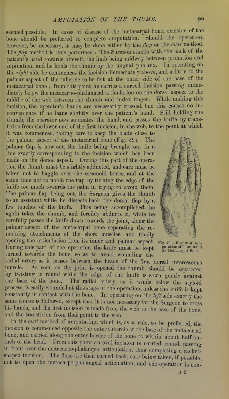 seemed possible. In cases of disease of the metacarpal bone, excision of the bone should be preferred to complete amputation. Should the operation, however, be necessary, it may be done either by the flap or the oval method. The flap method is thus peiformed : The Surgeon stands with the back of the patient's hand towards himself, the limb being midway between pronation and supination, and he holds the thumb by the ungual phalanx. In operating on the riffht side he commences the incision immediately above, and a little to the palmar aspect of the tubercle to be felt at the outer side of the base of the metacarpal bone ; from this point he carries a curved incision passing imme- diately below the metacarpo-phalangeal articulation on the dorsal aspect to the middle of the web between the thumb and index finger. While making this incision, the opei-ator's hands are necessarily crossed, but this causes no in- convenience if he leans slightly over the patient's hand. Still holding the thumb, the operator now supinates the hand, and passes the knife by trans- fixion from the lower end of the first incision, in the web, to the point at which it was commenced, taking care to keep the blade close to the palmar aspect of the metacarpal bone (Fig. 39). The palmar flap is now cut, the knife being brought out in a line exactly corresponding to the incision which has been made on the dorsal aspect. During this part of the opera- tion the thumb must be slightly adducted, and care must be taken not to haggle over the sesamoid bones, and at the same time not to notch the flap by turning the edge of the knife too much towards the palm in trying to avoid them. The palmar flap being cut, the Surgeon gives the thumb to an assistant while he dissects back the dorsal flap by a few touches of the knife. This being accomplished, he again takes the thumb, and forcibly abducts it, while he carefully passes the knife down towards the joint, along the palmar aspect of the metacarpal bone, sepai-ating the re- maining attachments of the short muscles, and finally opening the articulation from its inner and palmar aspect. During this part of the operation the knife must be kept turned towards the bone, so as to avoid wounding the radial artery as it passes between the heads of the first dorsal interosseous muscle. As soon as the joint is opened the thumb should be separated by twisting it round while the edge of the knife is sawn gently against the base of the bone. The radial artery, as it winds below the styloid process, is easily wounded at this stage of the operation, unless the knife is kept constantly in contact with the bone. In operating on the left side exactly the same course is followed, except that it is not necessary for the Surgeon to cross his hands, and the first incision is made from the web to the base of the bone, and the transfixion from that point to the web. ' In the oml method of amputating, which is, as a rule, to be preferred, the incision is commenced opposite the outer tubercle at the base of the metacarpal bone, and carried along the outer border of the bone to within about half-an- inch of the head. From this point an oval incision is carried round, passino- in front over the metacarpo-phalangeal articulation, thus completing a racket^ shaped incision. The flaps are then turned back, care being taken,tf possible not to open the metacarpo-phalangeal articulation, and the operation is con- u 2 Fig. M.—Result of Am- putation of Tliuiiibaiul its Metacarpal Bone.
