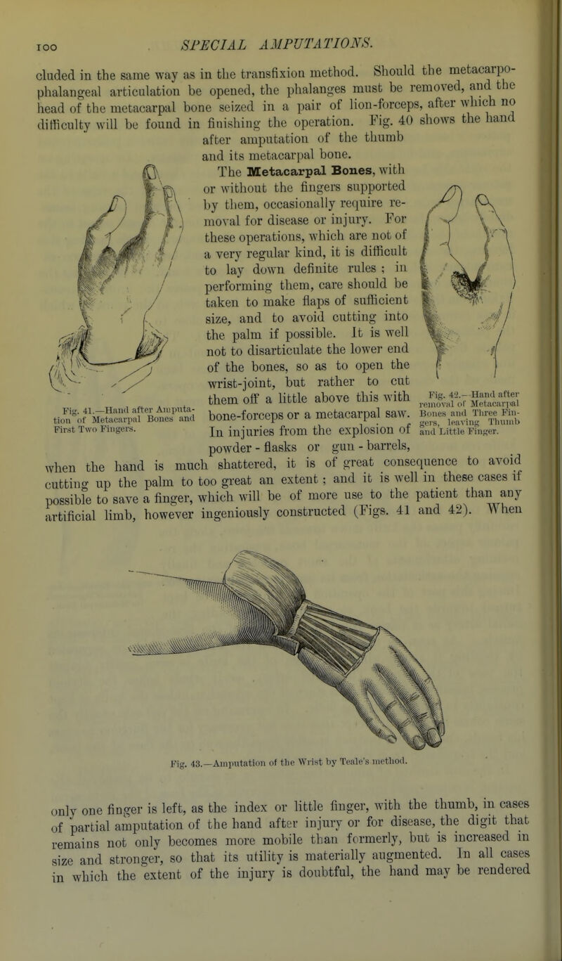TOO eluded in the same way as in the transfixion method. Should the metacarpo- phalangeal articulation be opened, the phalanges must be removed, and the head of the metacarpal bone seized in a pair of lion-forceps, after which no difficulty will be found in finishing the operation. Fig. 40 shows the hand after amputation of the thumb and its metacarpal bone. The Metacarpal Bones, with or without the fingers supported by them, occasionally require re- moval for disease or injury. For these operations, which are not of a very regular kind, it is difficult to lay down definite rules ; in performing them, care should be taken to make flaps of sufficient size, and to avoid cutting into the palm if possible. It is well not to disarticulate the lower end of the bones, so as to open the wrist-joint, but rather to cut them off' a little above this with bone-forceps or a metacarpal saw. In injuries from the explosion of powder - flasks or gun - barrels, when the hand is much shattered, it is of great consequence to avoid cuttino- up the palm to too great an extent; and it is well in these cases if possibfe to save a finger, which will be of more use to the patient than any artificial limb, however ingeniously constructed (Figs. 41 and 42). When Fig. 41.—Hand .after Aiiii)\ita- tion of Metacarpal Bones and First Two Fingers. Fig. 4-2.- Hand after removal oT Metacariial Bones an<l Tliree Fin- gers, leaving Tlninib and Little Finger. Fig. 43.—Amputation of tlie Wrist hy Teale's metliod. only one finger is left, as the index or little finger, with the thumb, m cases of partial amputation of the hand after injury or for disease, the digit that remains not only becomes more mobile than formerly, but is increased m size and stronger, so that its utility is materially augmented. In all cases in which the extent of the injury is doubtful, the hand may be rendered