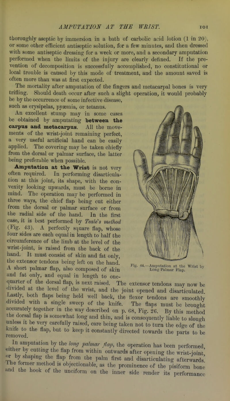 thoroughly aseptic by immersion in a bath of carbolic acid lotion (1 in 20J, or some other efficient antiseptic solution, for a few minutes, and then dressed with some antiseptic dressing for a week or more, and a secondary amputation performed when the limits of the injury are clearly defined. If the pre- vention of decomposition is successfally accomplished, no constitutional or local trouble is caused by this mode of treatment, and the amount saved is often more than was at first expected. The mortality after amputation of the fingers and metacarpal bones is very trifling. Should death occur after such a slight operation, it would probably be by the occurrence of some infective disease, such as erysipelas, pyaemia, or tetanns. An excellent stump may in some cases be obtained by amputating between the carpus and metacarpus. All the move- ments of the wrist-joint remaining perfect, a very useful artificial hand can be easily applied. The covering may be taken chiefly from the dorsal or palmar surface, the latter being preferable when possible. Amputation at the Wrist is not very often required. In performing disarticula- tion at this joint, its shape, with the con- vexity looking upwards, must be borne in mind. The operation may be performed in three ways, the chief flap being cut either from the dorsal or palmar surface or from the radial side of the hand. In the first case, it is best performed by Teale's method (Fig. 43). A perfectly square flap, whose four sides are each equal in length to half the circumference of the hmb at the level of the wrist-joint, is raised from the back of the hand. It must consist of skin and fat only, the extensor tendons being left on the hand. A short palmar flap, also composed of skin and fat only, and equal in length to one- quarter of the dorsal flap, is next raised. The extensor tendons may now be divided at the level of the wrist, and the joint opened and disarticulated Lastly both flaps being held well back, the flexor tendons are smoothly divided with a single sweep of the knife. The flaps must be brouo-ht accurately together m the way described on p. G8, Fig. 26. By this method t he dorsal flap is somewhat long and thin, and is consequently liable to slouo-h unless It be very carefully raised, care being taken not to turn the edge of the kuife to the flap, but to keep it constantly directed towards the parts to be removed. ^ In amputation by the long palmar flap, the operation has been performed either by cutting the flap from within outwards after opening the wrist-joint' ')r by shaping the flap from the palm first and disarticulating afterwards' Lhe former method is objectionable, as the prominence of the pisiform bone and the hook of the unciform on the inner side render its performance Fig. 44.—Auiimtation at tlie Wrist by Long Palmar Flap.