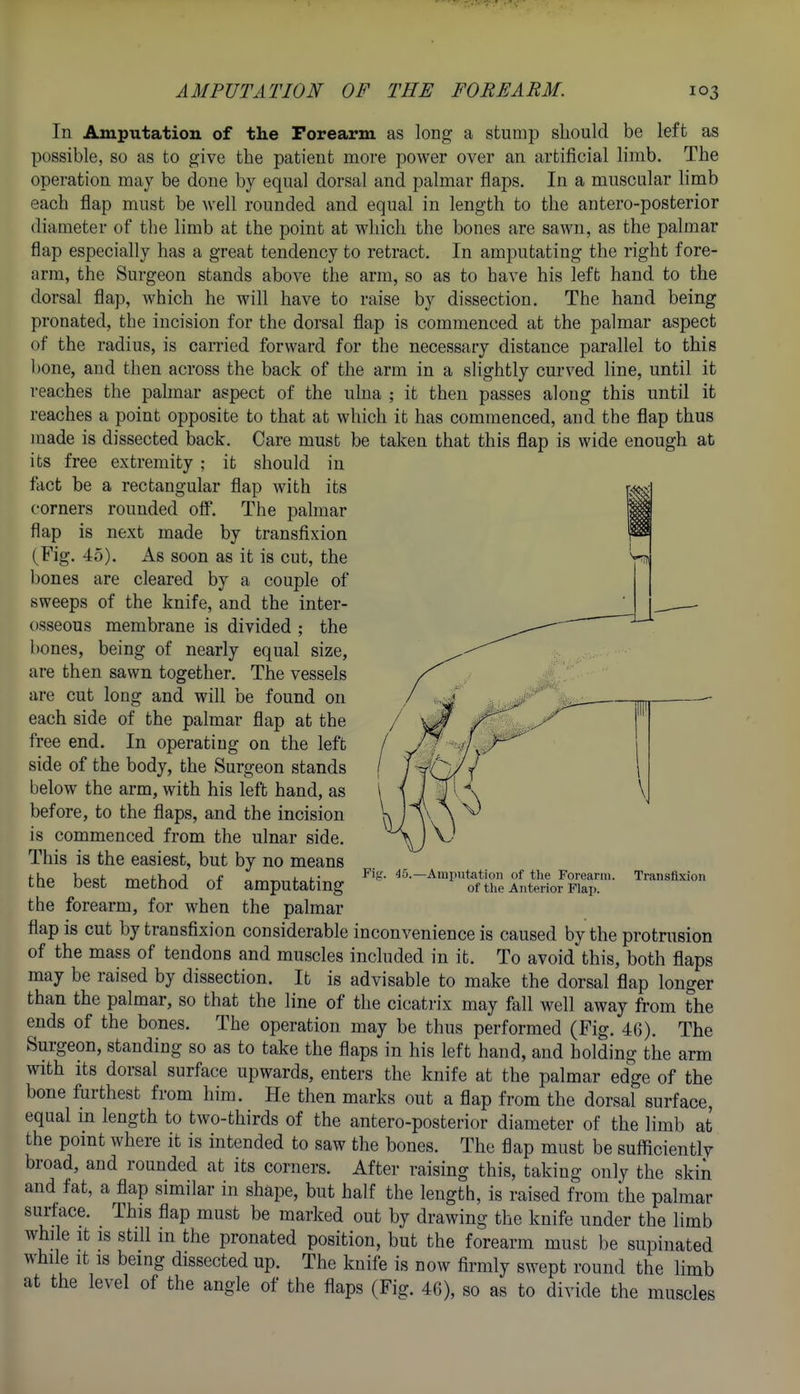 In Amputation of the Forearm as long a stump should be left as possible, so as to give the patient more power over an artificial limb. The operation may be done by equal dorsal and palmar flaps. In a muscular limb each flap must be well rounded and equal in length to the antero-posterior diameter of the limb at the point at which the bones are sawn, as the palmar flap especially has a great tendency to retract. In amputating the right fore- arm, the Surgeon stands above the arm, so as to have his left hand to the dorsal flap, which he will have to raise by dissection. The hand being pronated, the incision for the dorsal flap is commenced at the palmar aspect of the radius, is carried forward for the necessary distance parallel to this bone, and then across the back of the arm in a slightly curved line, until it reaches the palmar aspect of the ulna ; it then passes along this until it reaches a point opposite to that at which it has commenced, and the flap thus made is dissected back. Care must be taken that this flap is wide enough at its free extremity ; it should in fact be a rectangular flap with its corners rounded off. The palmar flap is next made by transfixion (Fig. 45). As soon as it is cut, the bones are cleared by a couple of sweeps of the knife, and the inter- osseous membrane is divided ; the bones, being of nearly equal size, are then sawn together. The vessels are cut long and will be found on each side of the palmar flap at the free end. In operating on the left side of the body, the Surgeon stands below the arm, with his left hand, as before, to the flaps, and the incision is commenced from the ulnar side. This is the easiest, but by no means the best method of amputating the forearm, for when the palmar flap is cut by transfixion considerable inconvenience is caused by the protrusion of the mass of tendons and muscles included in it. To avoid this, both flaps may be raised by dissection. It is advisable to make the dorsal flap longer than the palmar, so that the line of the cicatrix may fall well away from the ends of the bones. The operation may be thus performed (Fig. 46). The Surgeon, standing so as to take the flaps in his left hand, and holding the arm with its dorsal surface upwards, enters the knife at the palmar edge of the bone furthest from him. He then marks out a flap from the dorsal surface, equal in length to two-thirds of the antero-posterior diameter of the limb at the point where it is intended to saw the bones. The flap must be sufficientlv broad, and rounded at its corners. After raising this, taking only the skin and fat, a flap similar in shape, but half the length, is raised from the palmar surface. This flap must be marked out by drawing the knife under the limb while It IS still m the pronated position, but the forearm must be supinated while It IS being dissected up. The knife is now firmly swept round the limb at the level of the angle of the flaps (Fig. 46), so as to divide the muscles Fis. 45.- -Ami>utation of the Forearm, of tlie Anterior Flap. Transfixion